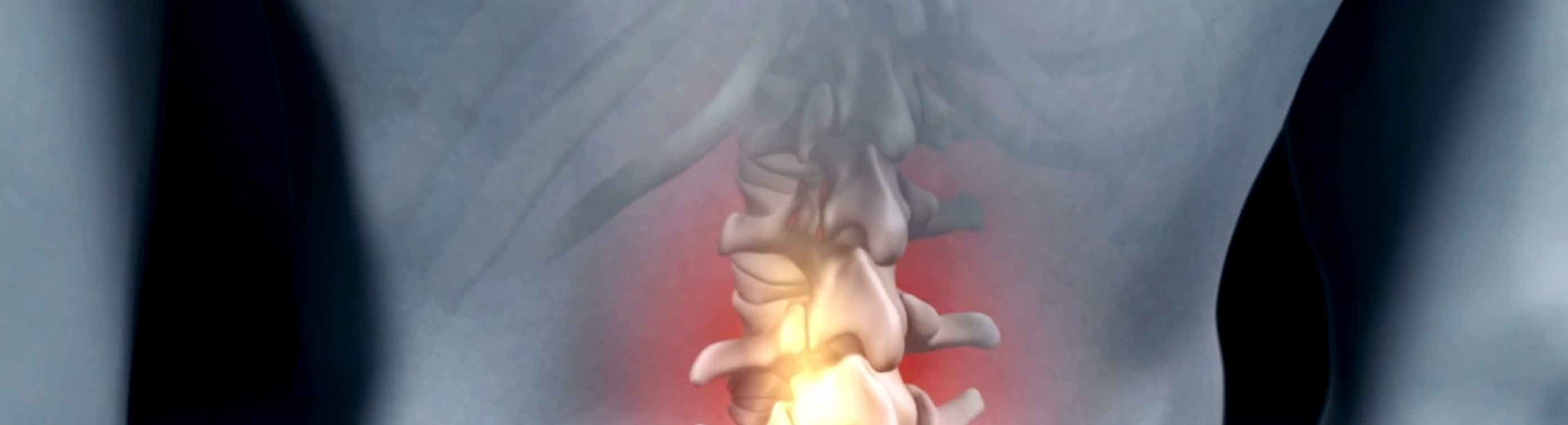 Medical Animation Case Study: Vionic® Orthaheel visuals