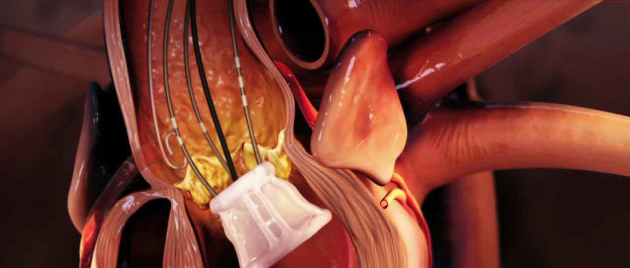 Emerging Technology And Innovative Surgical Methods for Aortic Valve Replacement