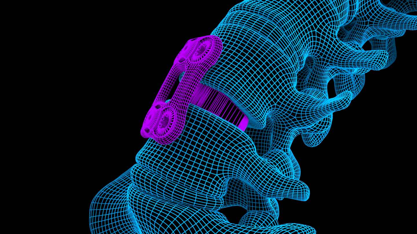 Pre-Production Image of Spinal Medical Device.