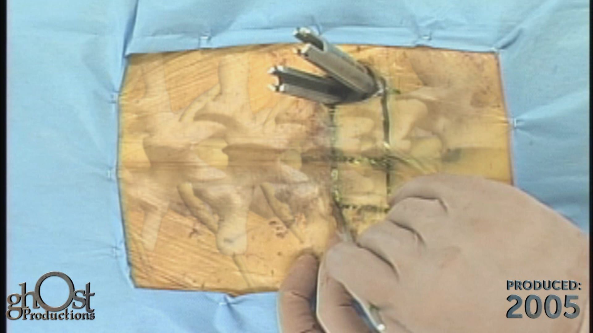 Abbott Spine, Ghost Productions, minimally invasive spinal fixation, posterior technique, Pathfinder Traxis, surgical footage, 3D animation, comprehensive understanding, cutting-edge product, spinal fixation, medical professionals, patients, innovative technique, medically accurate content, attention-grabbing visuals, valuable asset, spinal medicine.