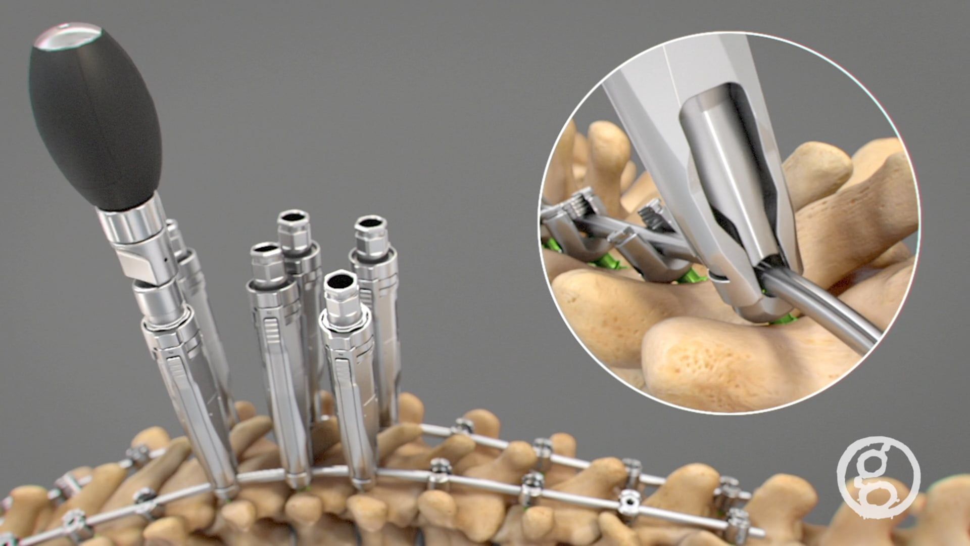 spine orthopedics, animation demo, OptiLIF®, MIS Discectomy, Ti3Z Interbody implants, Vital™ Spinal Fixation System, Prism AQUILA-BOREALIS ACDF Spinal System, Tether™ Vertebral Body Tethering System, Simplify Disc, eZspand™ PLIF, Tara Tether Character, back brace, Scoliosis Pathology, medical companies, Zimmer Biomet, NuVasive, Spineology, Ghost Productions, creative team, expertise.