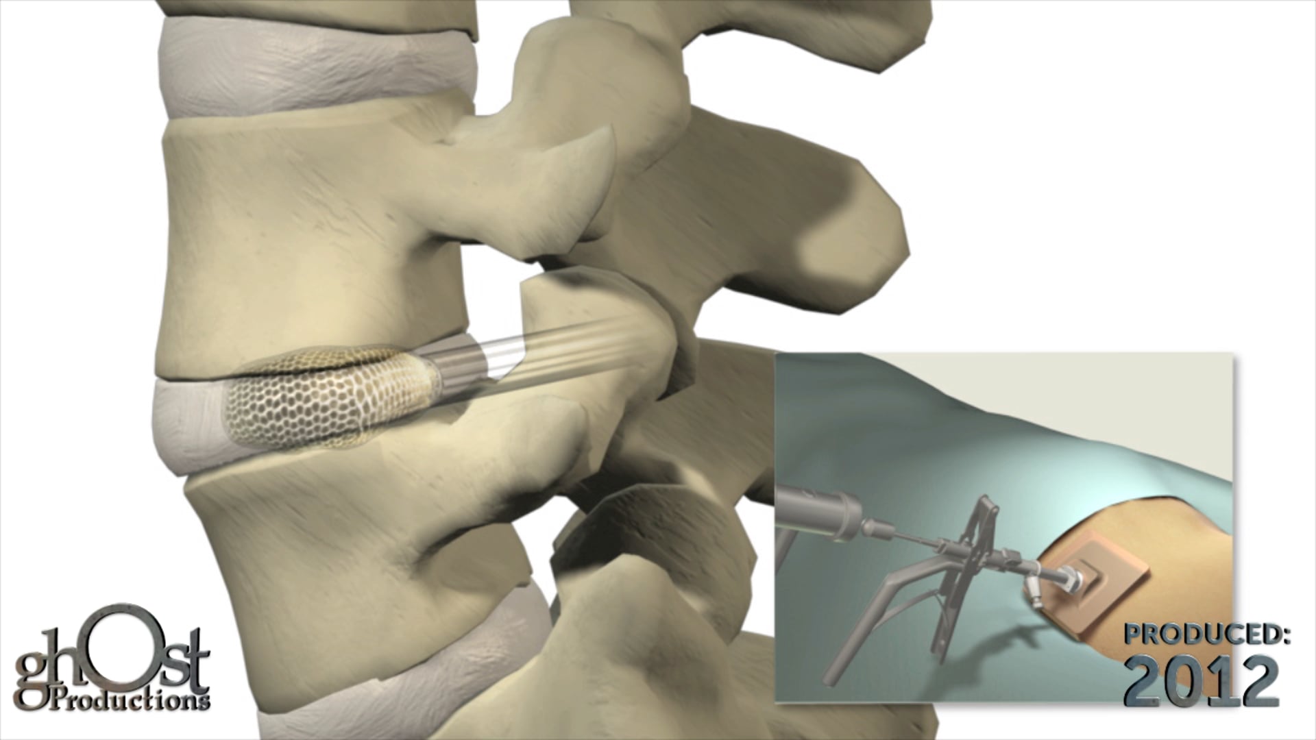 Spineology, Ghost Productions, OptiMesh 1500e, medical device, spinal fusion procedures, deployable mesh implant, expanding instrumentation, granular bone graft, stable foundation, visually engaging, unique features, benefits, healthcare professionals, patients, medical animation, innovative technology, spinal fusion surgery, medical accuracy.