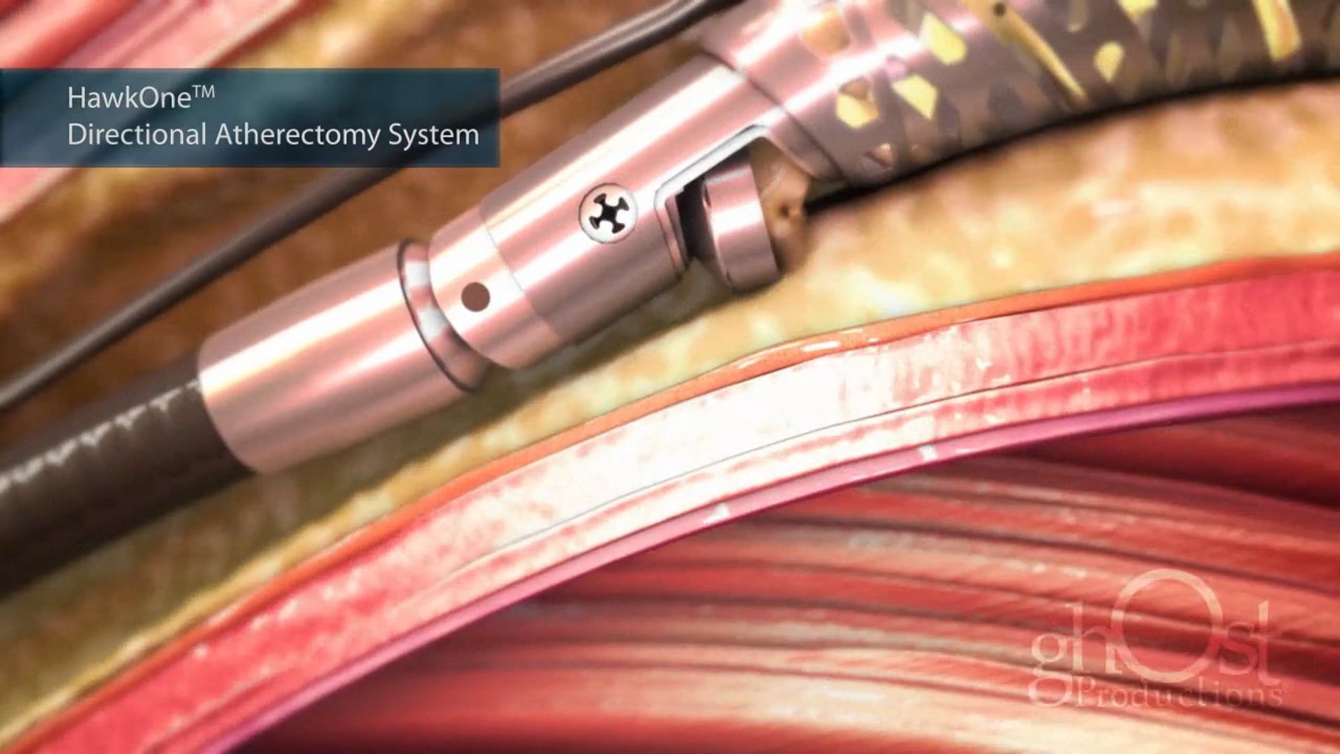 Ghost Medical Presents: HawkOne by Medtronic