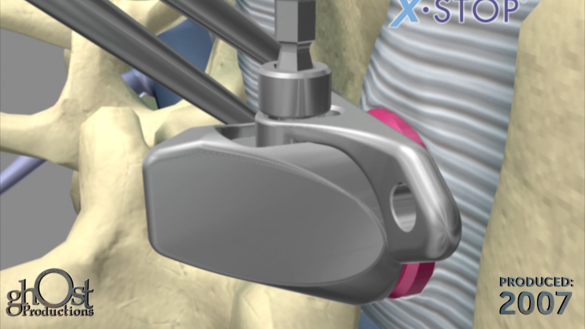 Medtronic, Xstop device, spinal stenosis, hybrid animation, surgical technique, interspinous spacer, pain relief, medically accurate, implantation, game-changer, spinal medicine, patient education, medical professional education, benefits.