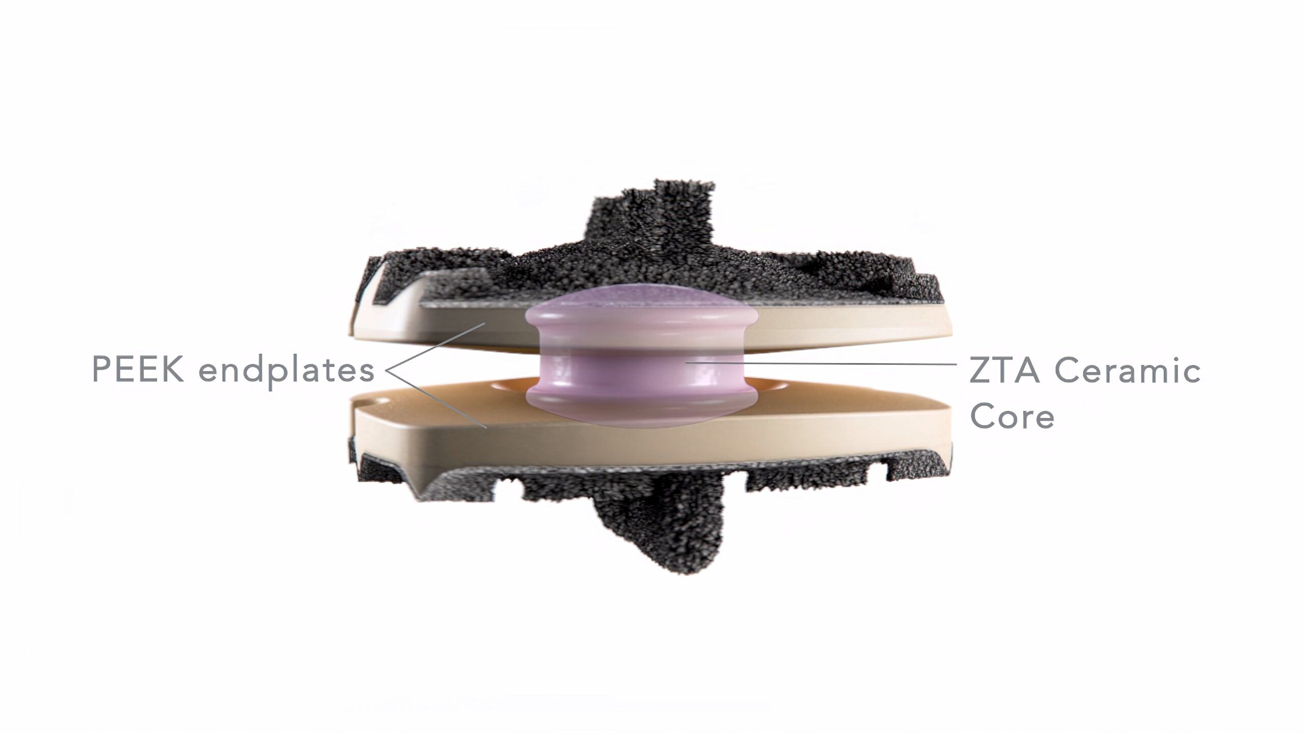 Simplify Cervical Artificial Disc, medical device, cervical disc degeneration, three-piece design, patient anatomies, superior endplate, vertebral bodies, retention ring, core expulsion, vertebral fixation, stable solution, cervical disc issues, orthopedic medicine, minimally invasive alternative, spinal fusion surgery.