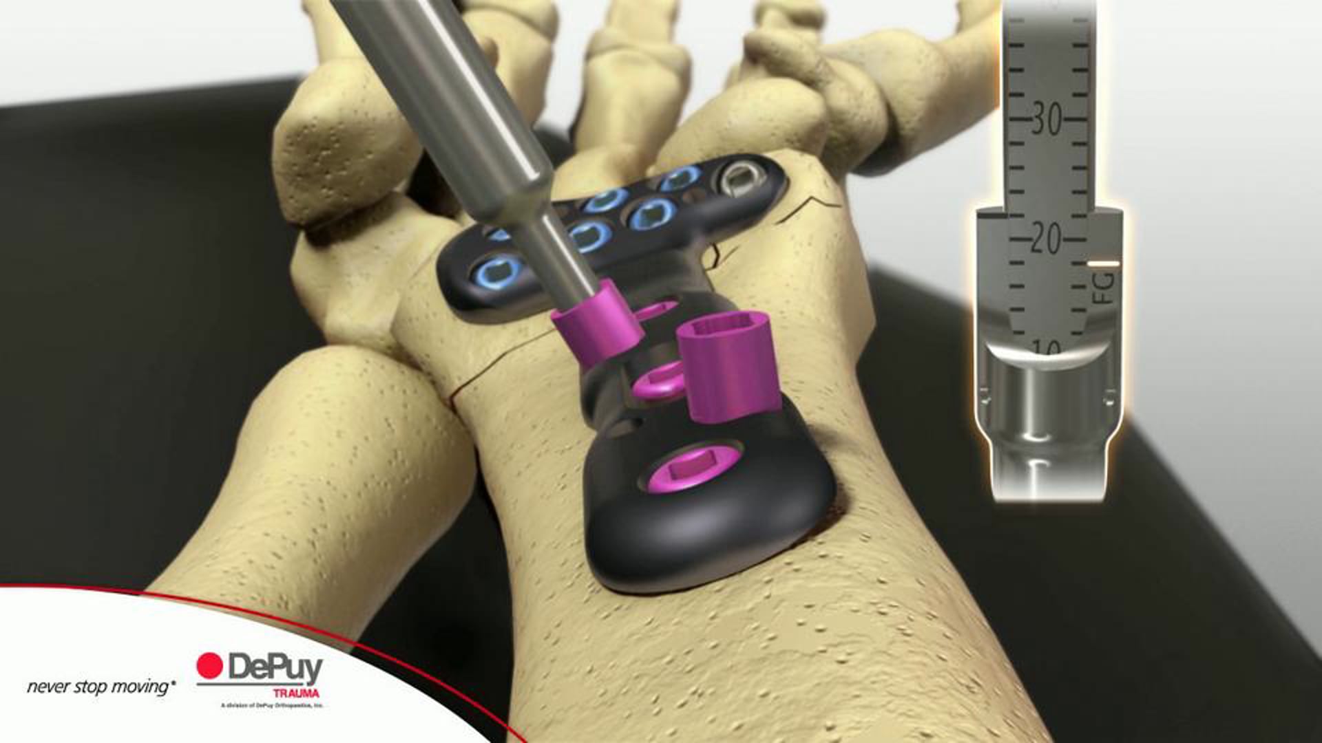 DePuy Trauma, Upper Extremity Group, surgical technique animation, DVR Nexgen Surgical Technique, Ghost Productions, advancements in surgical techniques, upper extremity procedures, medical professionals, comprehensive guide, precision, accuracy, medically accurate, informative, key steps, benefits, orthopedic surgery, invaluable resource, high quality, relevance, search engines.