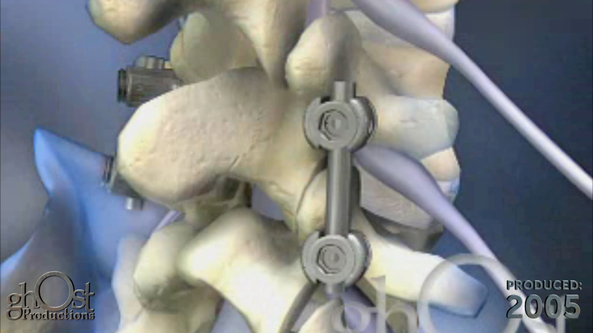 Ghost Productions, medical animation, spinal fusion procedure, sciatic nerve pain, advanced medical technology, patient outcomes, healthcare professionals, patients, orthopedic medicine, high-quality medical animations, education, information, engaging content, audience resonance, must-watch, potential benefits.