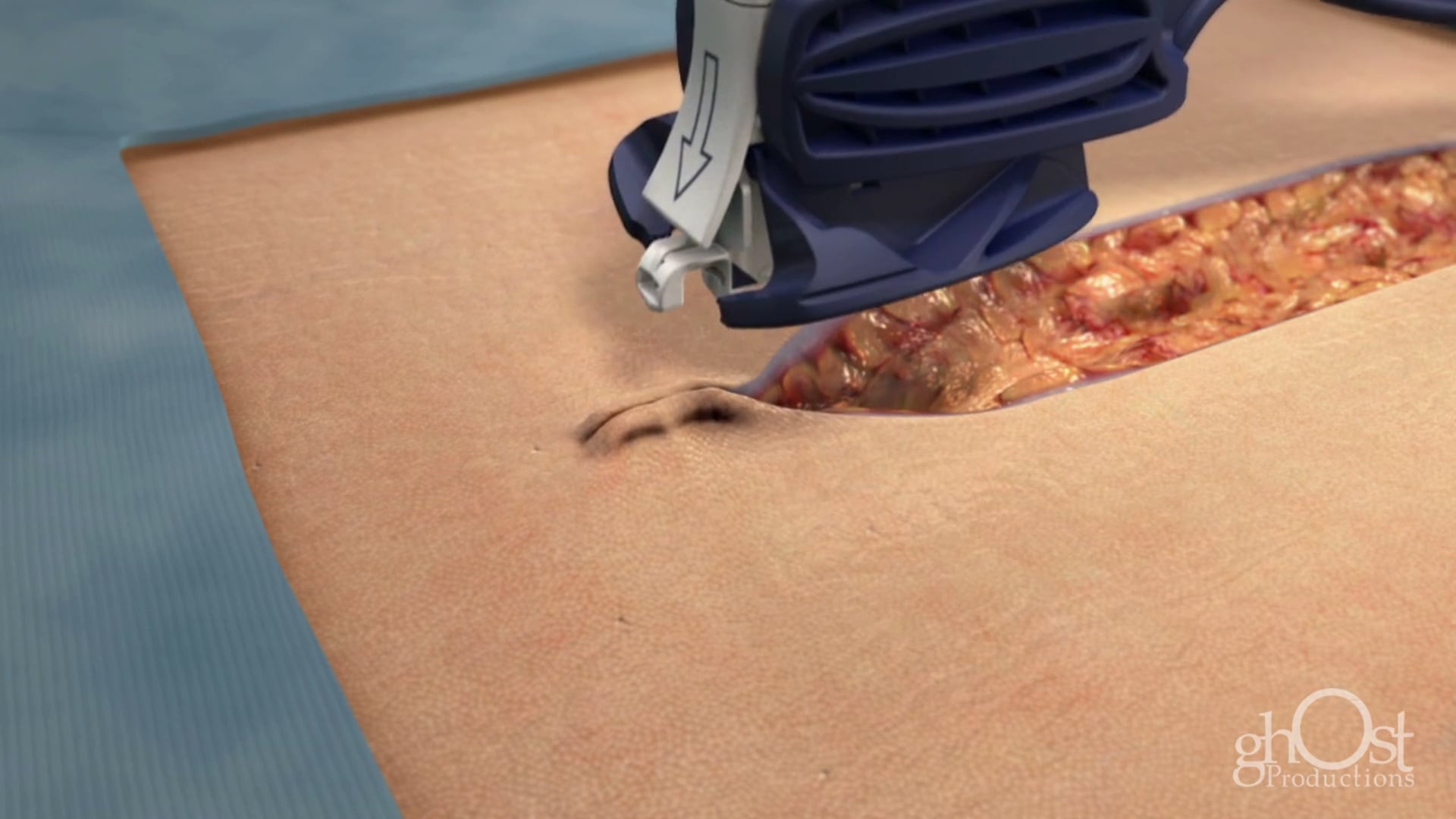 Ghost Medical Presents: Incisive Surgical's Insorb in HD