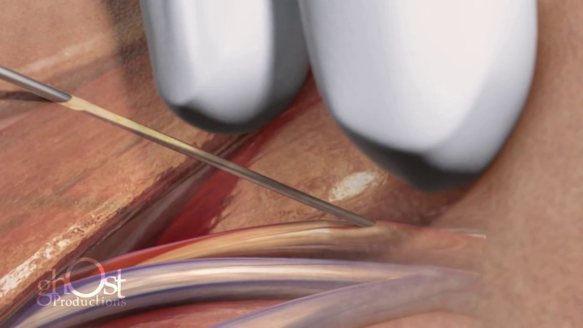 We offer detailed medical animations of heart anatomy and physiology, including the latest advancements in coronary treatment and technology. Our animations are a valuable resource for patient education and training, and can help medical professionals improve their understanding of cardiovascular disease and communication skills. Contact us to learn more about our services and stay ahead in the field of cardiology.