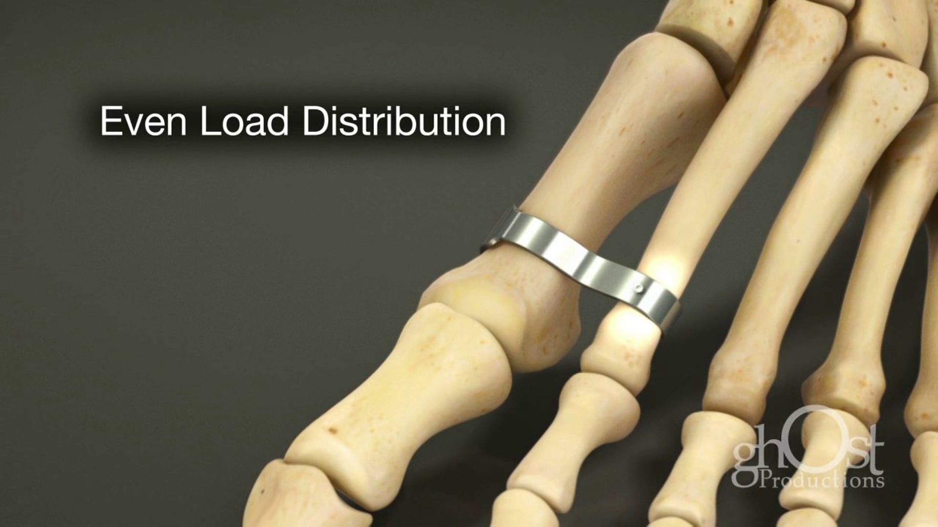 Ghost Productions, medical animation, Distal Clasp, orthodontics, anatomy, motion graphics, game-changing device, secure fit, comfortable fit, essential tool, orthodontists, latest advancements, orthodontic technology.