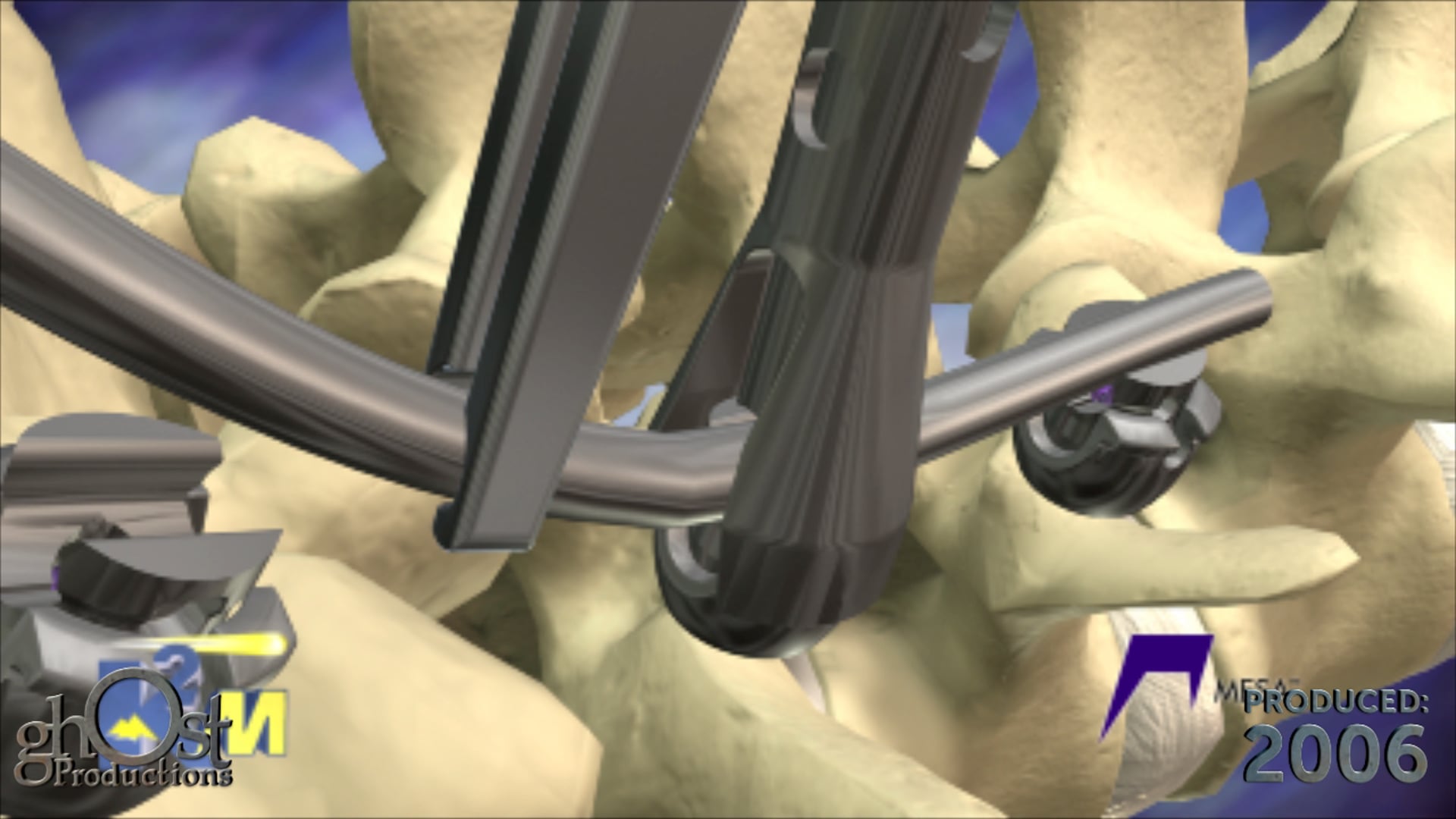 K2M, Mini Mesa, pedicle screw system, Ghost Productions, surgical technique, spinal surgery, medical professionals, researchers, comprehensive overview, cutting-edge technology, innovative surgical techniques, latest developments.