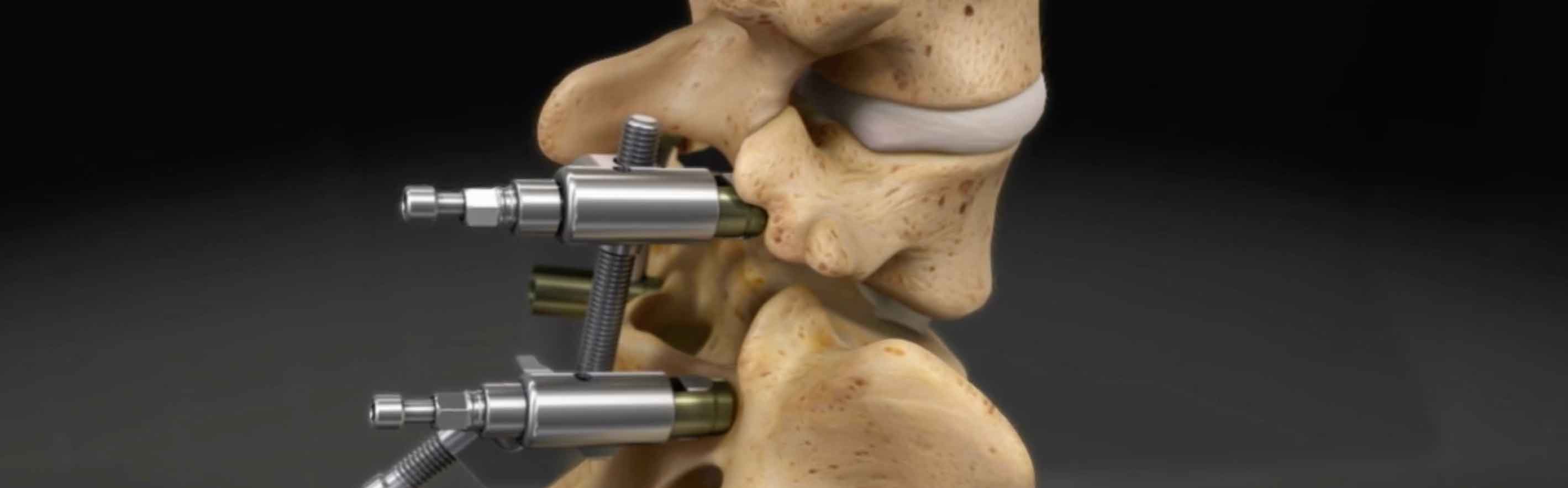 Medical Animation Case Study: Aesculap – S4 SRI | Blog