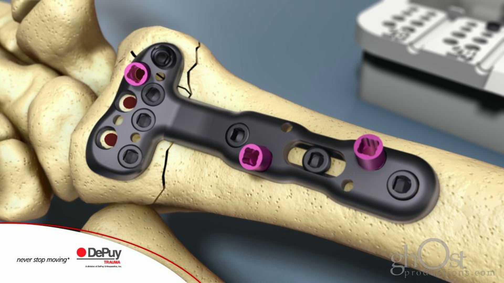 DePuy Trauma, Ghost Productions, informative animation, DVR Crosslock hardware kit, surgical technique, medically accurate depiction, orthopedic trauma surgery, intricate details, precise surgical technique, successful implantation, valuable resource, medical professionals, application.
