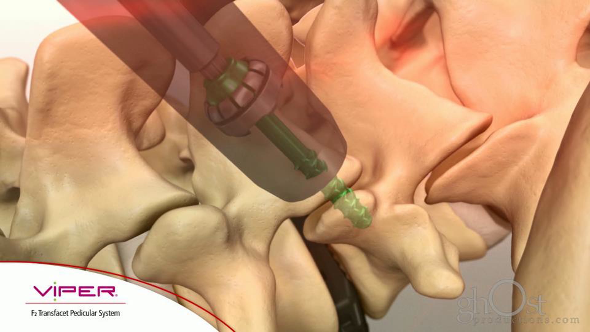 Depuy, Viper F2, Transfacet Pedicular System, animation, Ghost Productions, spine stabilization, fusion, transfacet fixation, medical accuracy, unique features, benefits, orthopedics, spinal surgery, cutting-edge product, search engine results.