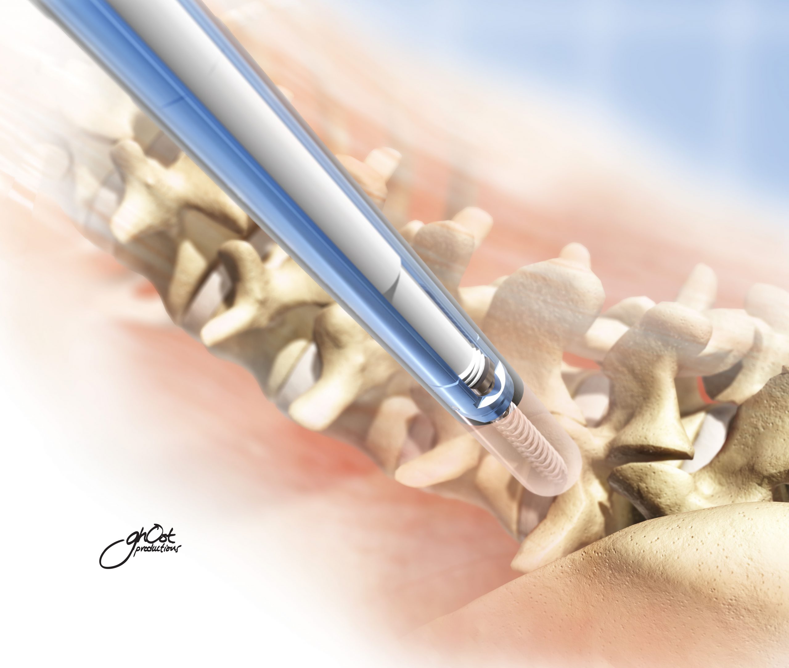 Posterior Spinal Fixation Animation Case Study: FacetLink, Inc.