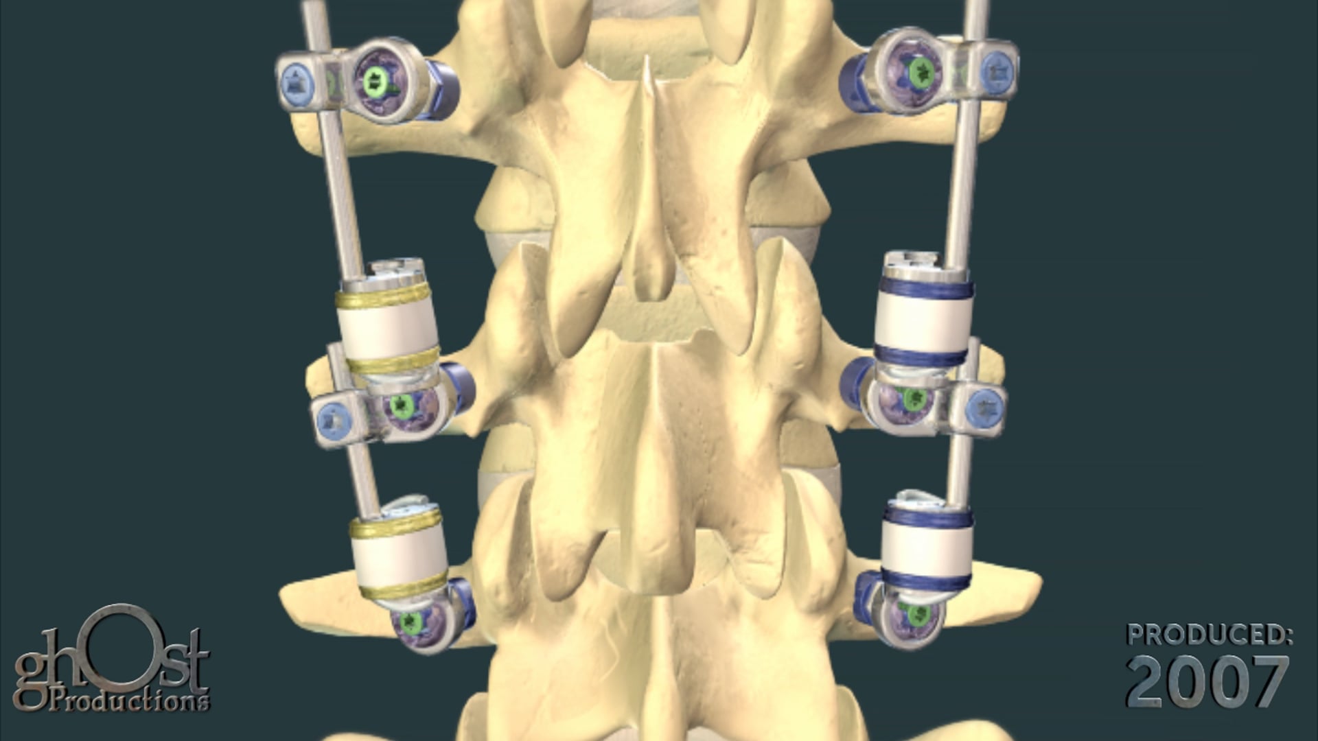 Stabilimax NZ, pedicle screw fixation system, degenerative spinal stenosis, Applied Spine, motion limitation, flexibility retention, patient relief, Ghost Productions, animation, spinal stenosis treatment.