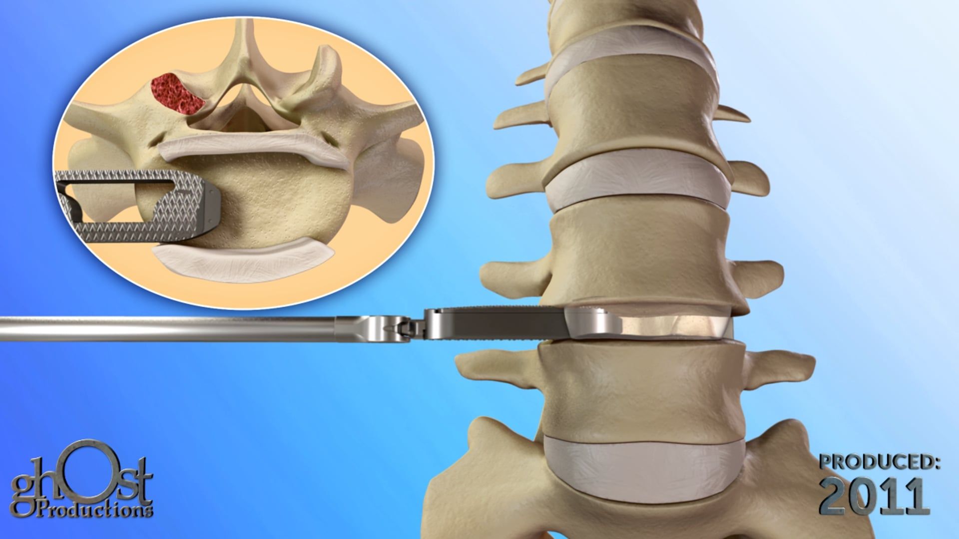 Ghost Medical Presents: CoAlign Lateral Animation