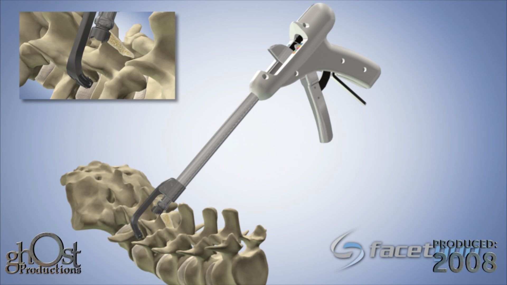 Ghost Medical Presents: US Spine Facet Gun with VBR Technology