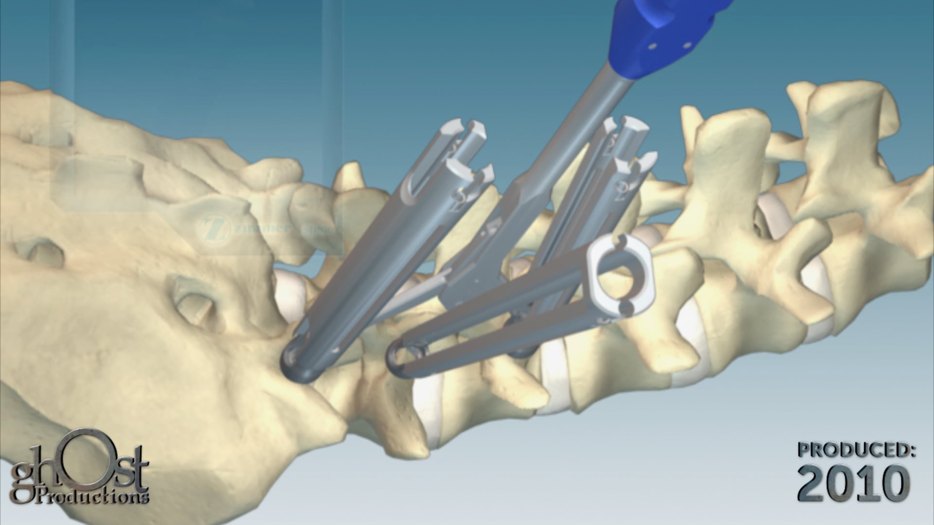 Zimmer Spine, Pathfinder system, minimally invasive pedicle screw system, vertebrae fusion, Ghost Productions, medical animation, unique features, benefits, medically accurate, spinal surgery, advanced technology, innovative design, game-changer, spinal fusion, cutting-edge product, patients, healthcare providers.