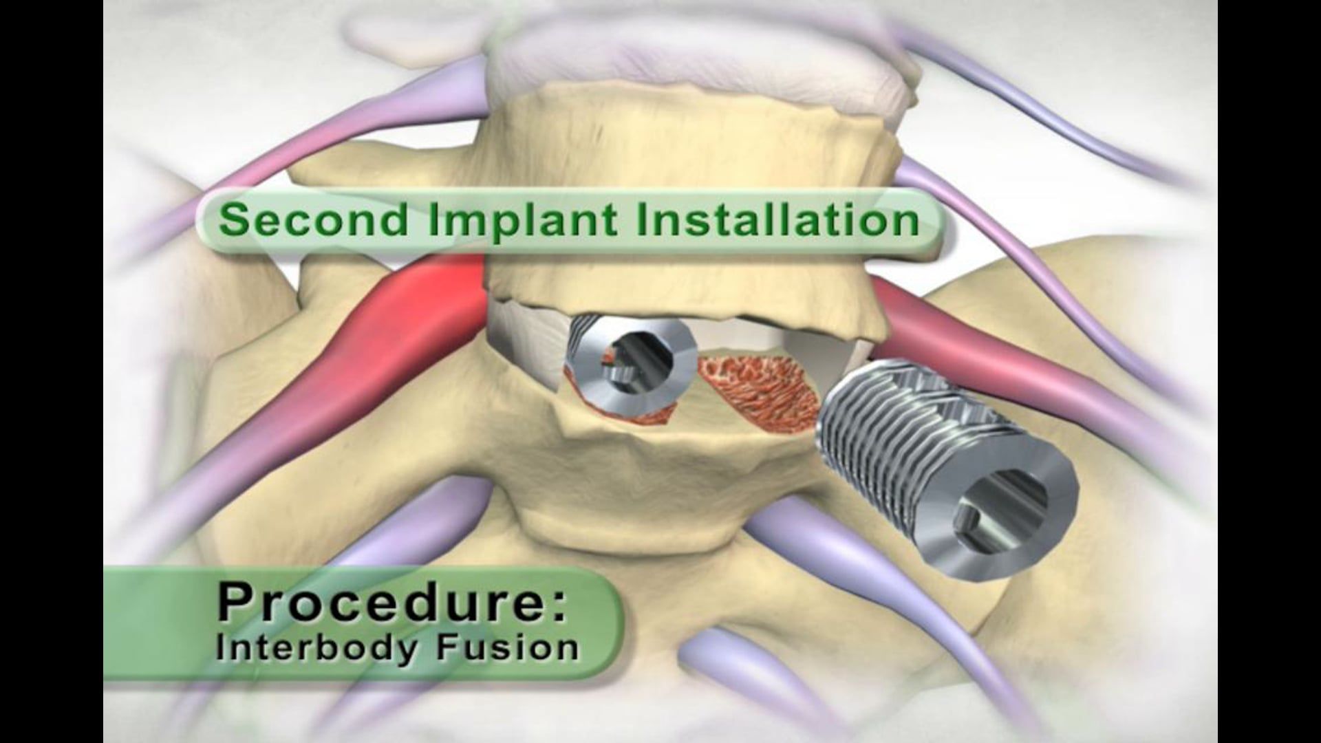 Spinal medicine, age and injury effects, bone spurs, nerve root irritation, discectomy procedure, sciatica pain relief, step-by-step demonstration, disc material removal, distractor insertion, spaced implants, medical animation, Ghost Productions, educational video, .edu websites, .org websites, active link, www.ghostproductions.com.