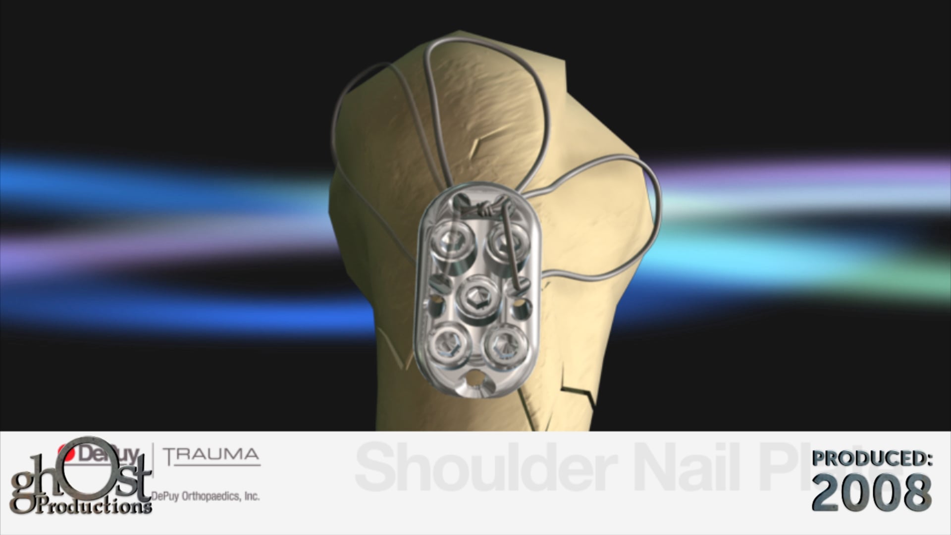 Depuy, S3 SNP, shoulder nail plate, surgical technique, animation, Ghost Productions, proximal humerus fractures, spacial subchondral support, stability, less invasive process, medical professionals, orthopedics, intricate surgical process, S3 SNP system.