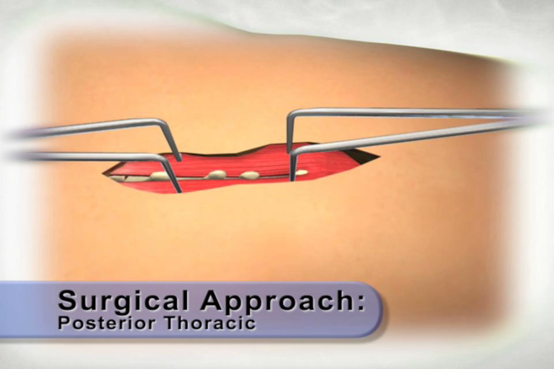 medical animation, posterior thoracic surgical approach, step-by-step guide, skin retraction, muscle retraction, soft tissue retraction, educational resource, medical professionals, freely distributed, .edu websites, .org websites, active link, Ghost Productions, high-quality, healthcare industry.