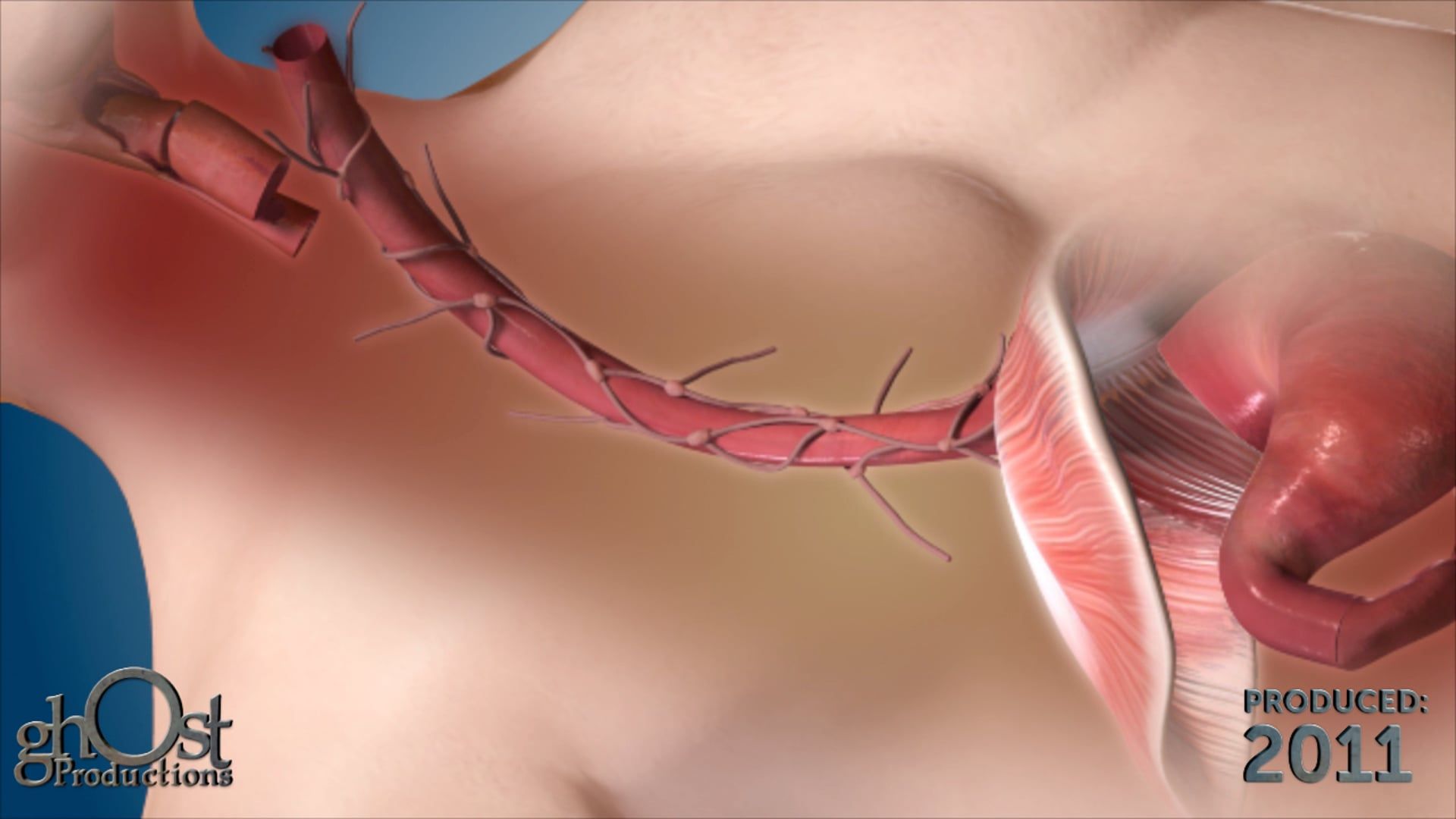 Ghost Medical Presents: The Esophagectomy Procedure