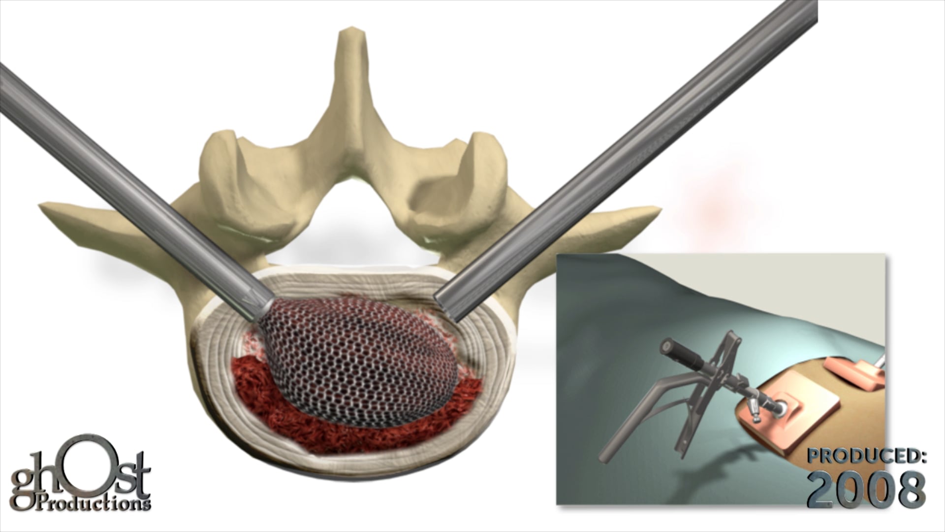 Spineology, OptiMesh system, interbody system, mesh implant, expanding instrumentation, spinal support, technique animation, innovative design, functionality, granular bone graft, spinal surgery, medical advancements.