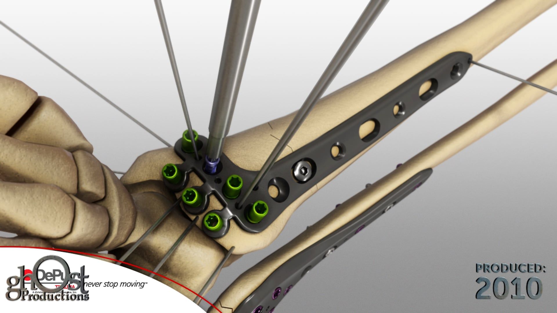 Depuy, Ghost Productions, Distal Tibia plating system, lower tibial fractures, cortex screws, locking screws, cancellous screws, proper healing, orthopedic medicine, medical animation, medical device, informative animation, medical professionals, patients, bone healing.