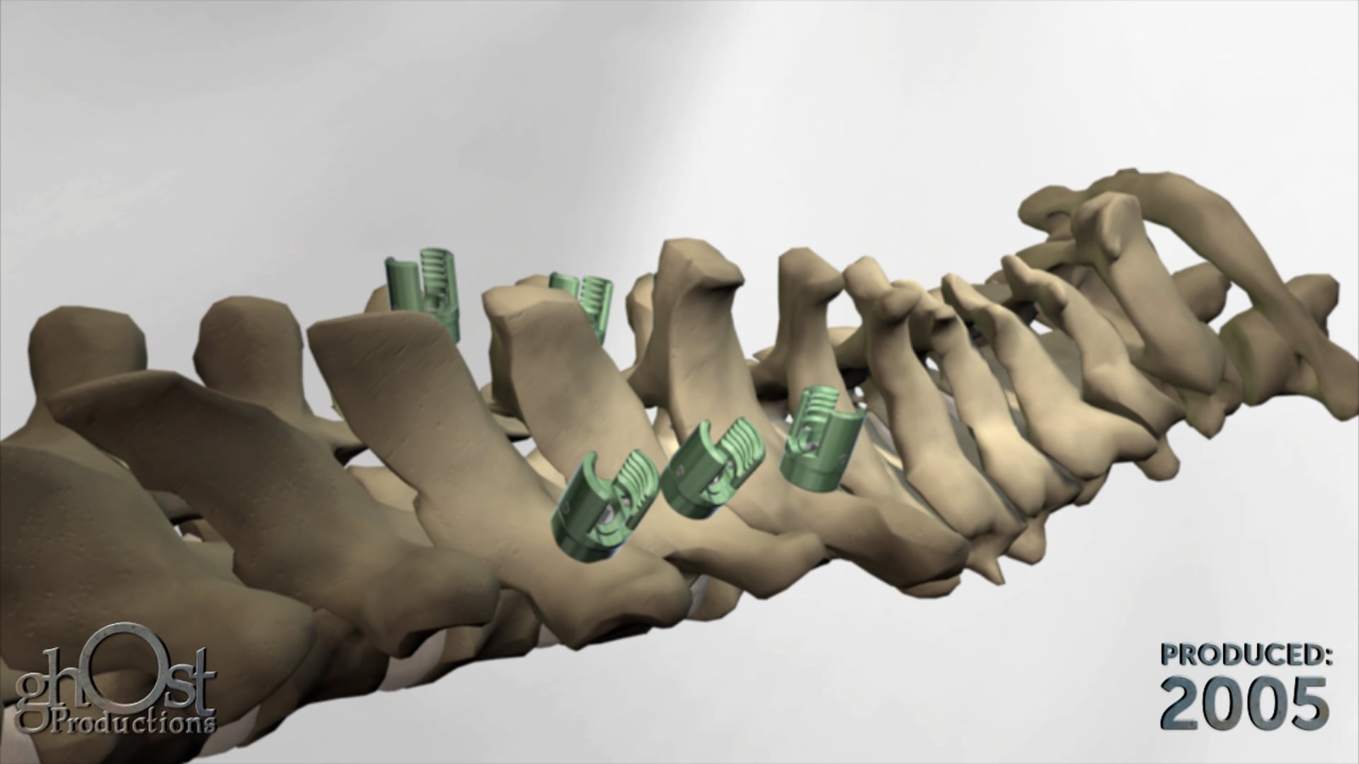 SeaSpine, Ghost Productions, medical device company, surgical technique animation, Sierra spinal fixation system, occipito-cervico-thoracic system, posterior occipital-cervical, upper thoracic spine, intricate details, unique features, benefits for patients, healthcare professionals, orthopedic surgery, spinal reconstruction.