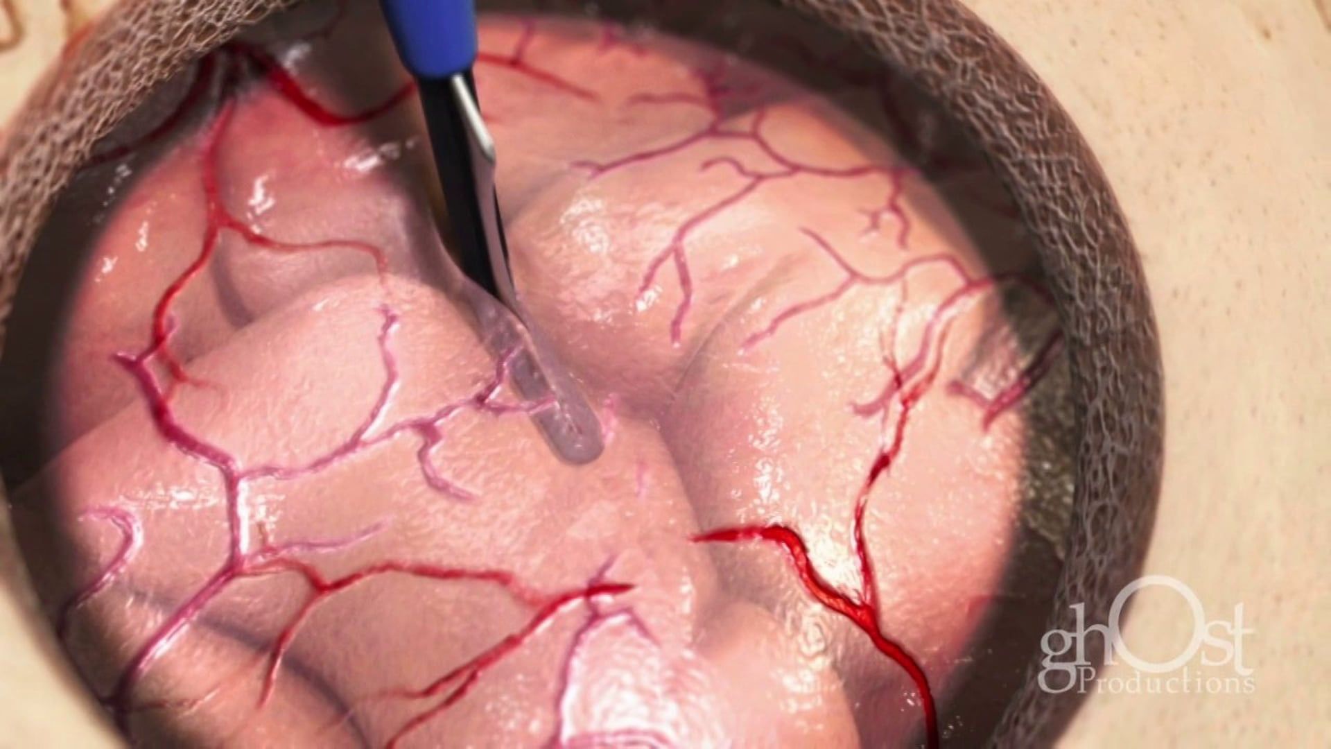 Ghost Medical - Osteomed - DuraKnife Animation