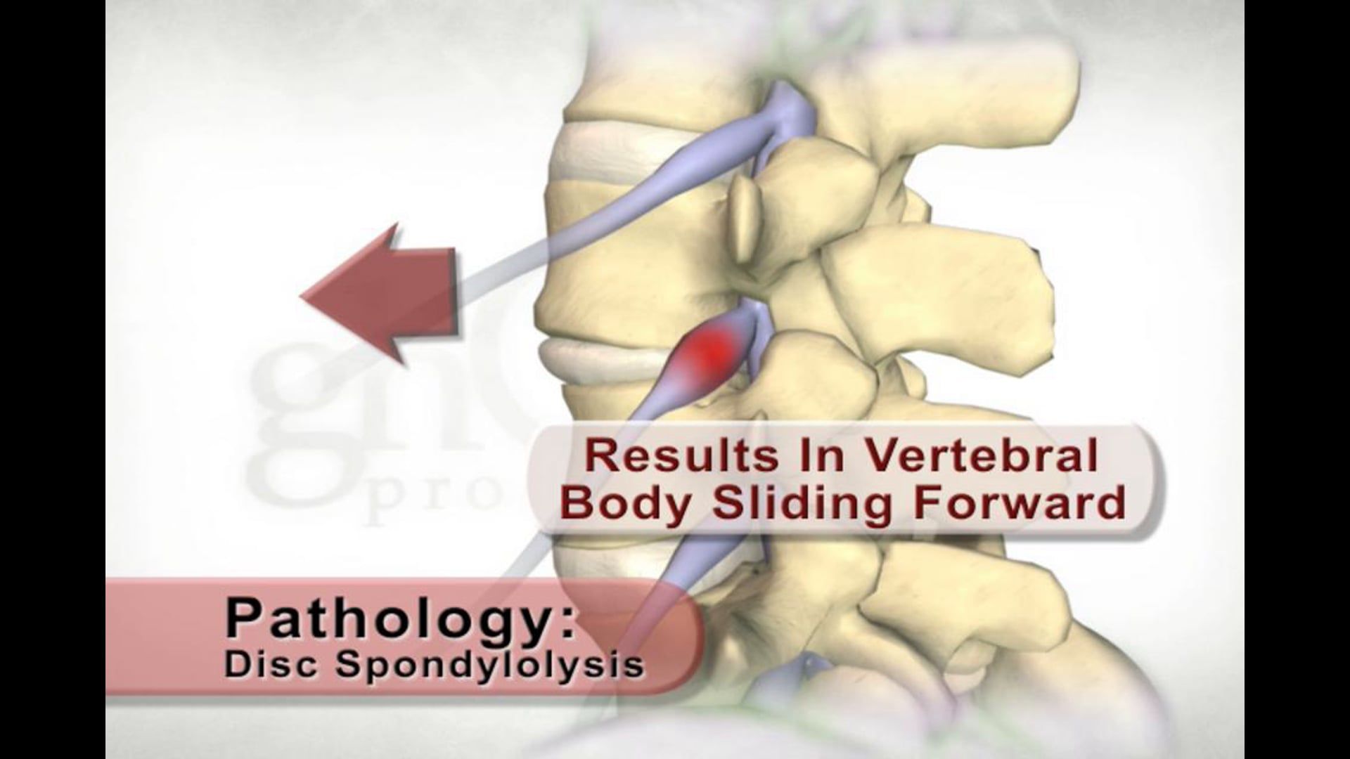 Disc Spondylolysis, spine condition, medical animation, nerve irritation, spinal disorders, healthcare professionals, patient education, Ghost Productions, medical accuracy, lamina integrity, vertebral body sliding forward, informative video, valuable information, client's product, educational resource.