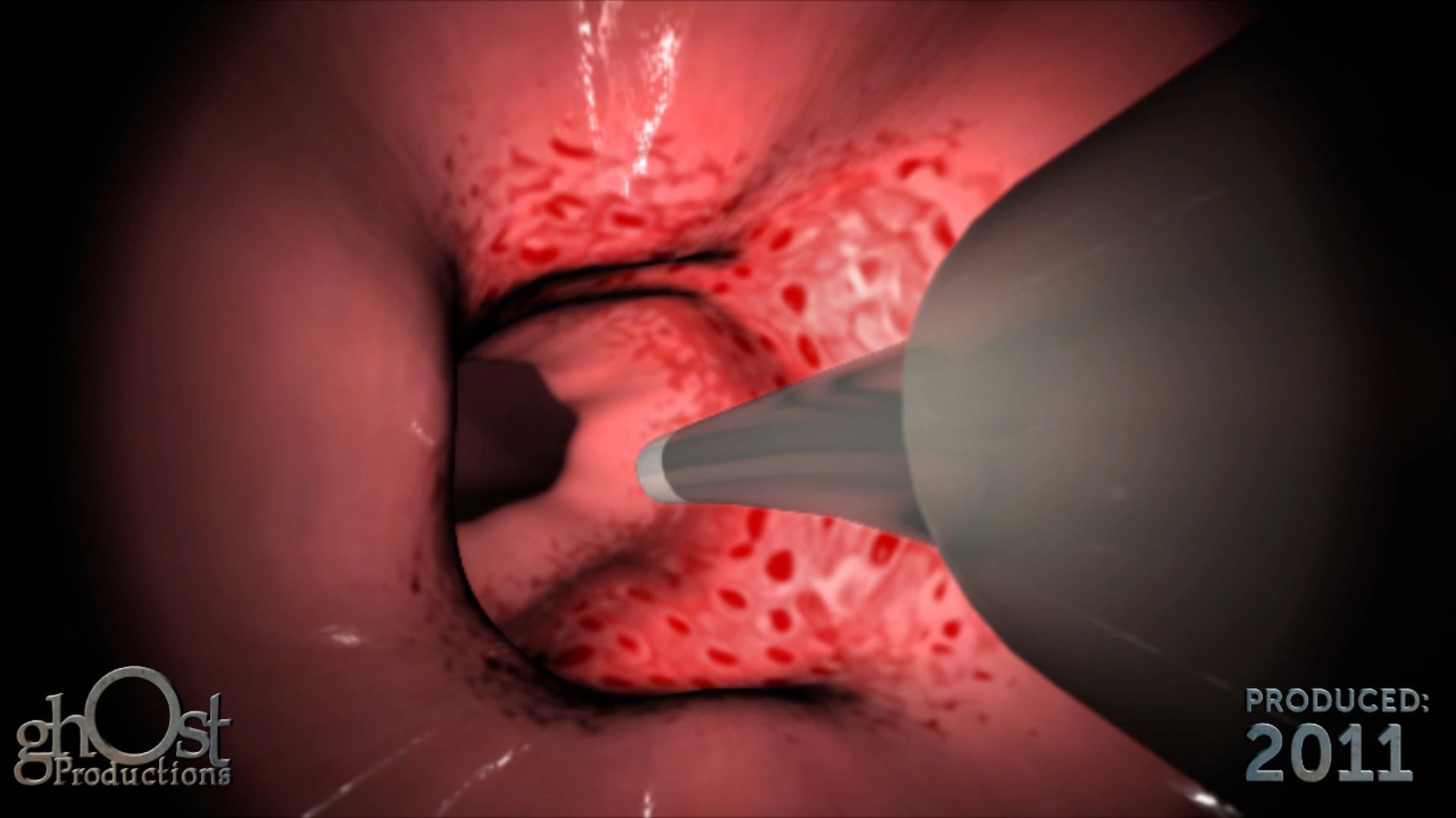 Ghost Medical Presents: CryoAblation - A Revolutionary Treatment for Cardiac Arrhythmias