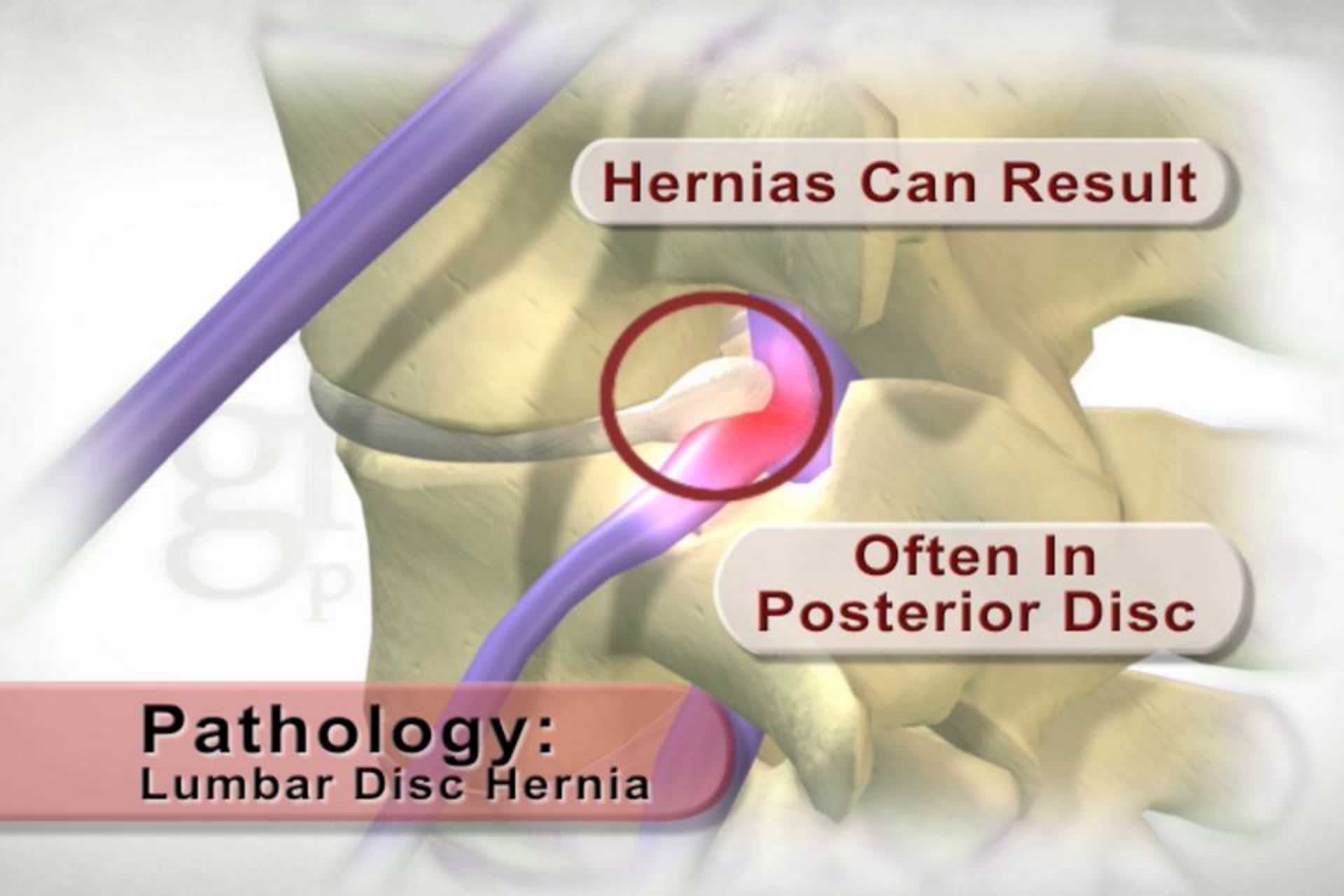 medical animation, axial stress, spine, disc annulus, hernias, posterior disc, nerve root irritation, educational video, medical education, Ghost Productions, medical accuracy, medical resource, .edu websites, .org websites, active link, www.ghostproductions.com