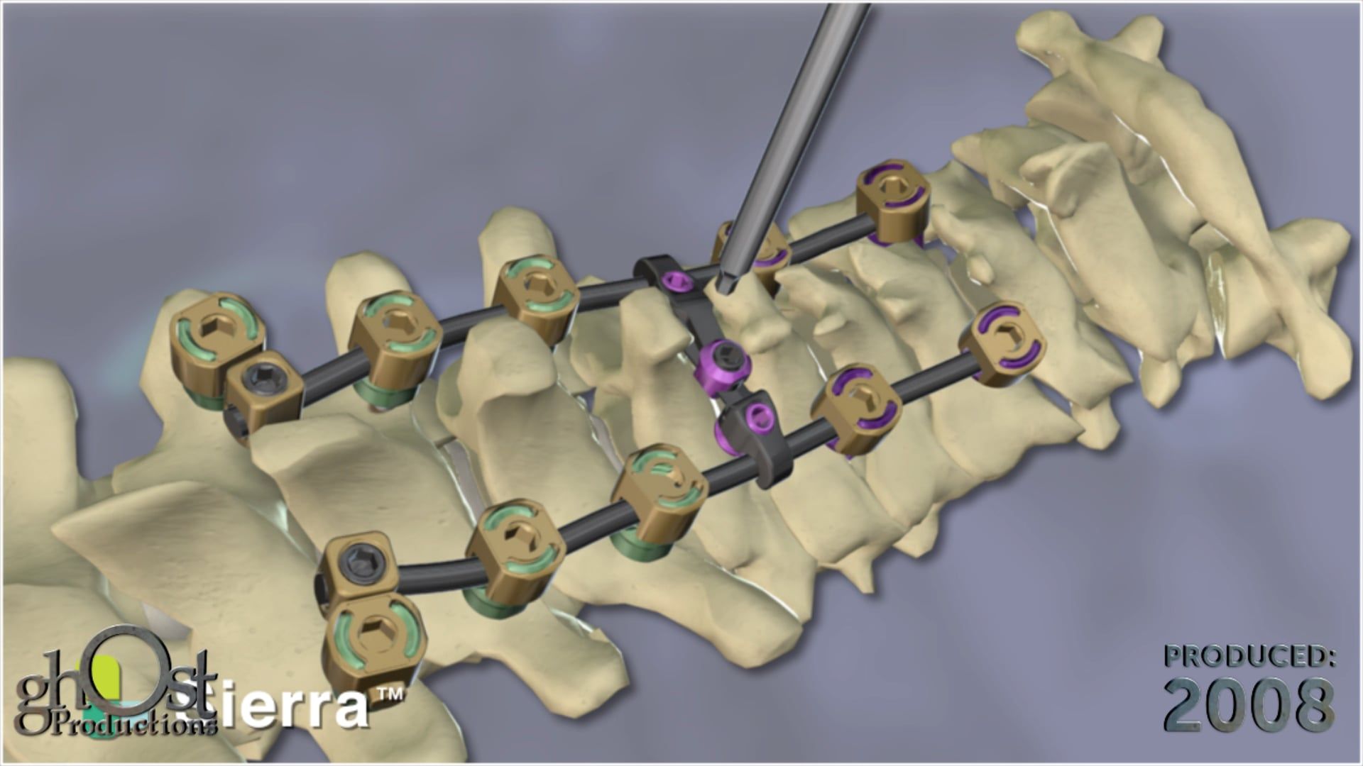 SeaSpine, Ghost Productions, Sierra device, occipito-cervico-thoracic system, posterior occipital-cervical, upper thoracic spine, medical animation, medical device, spine surgery, patient care, medical professionals, patient outcomes, innovative design, reconstruction, visually stunning, medically accurate.