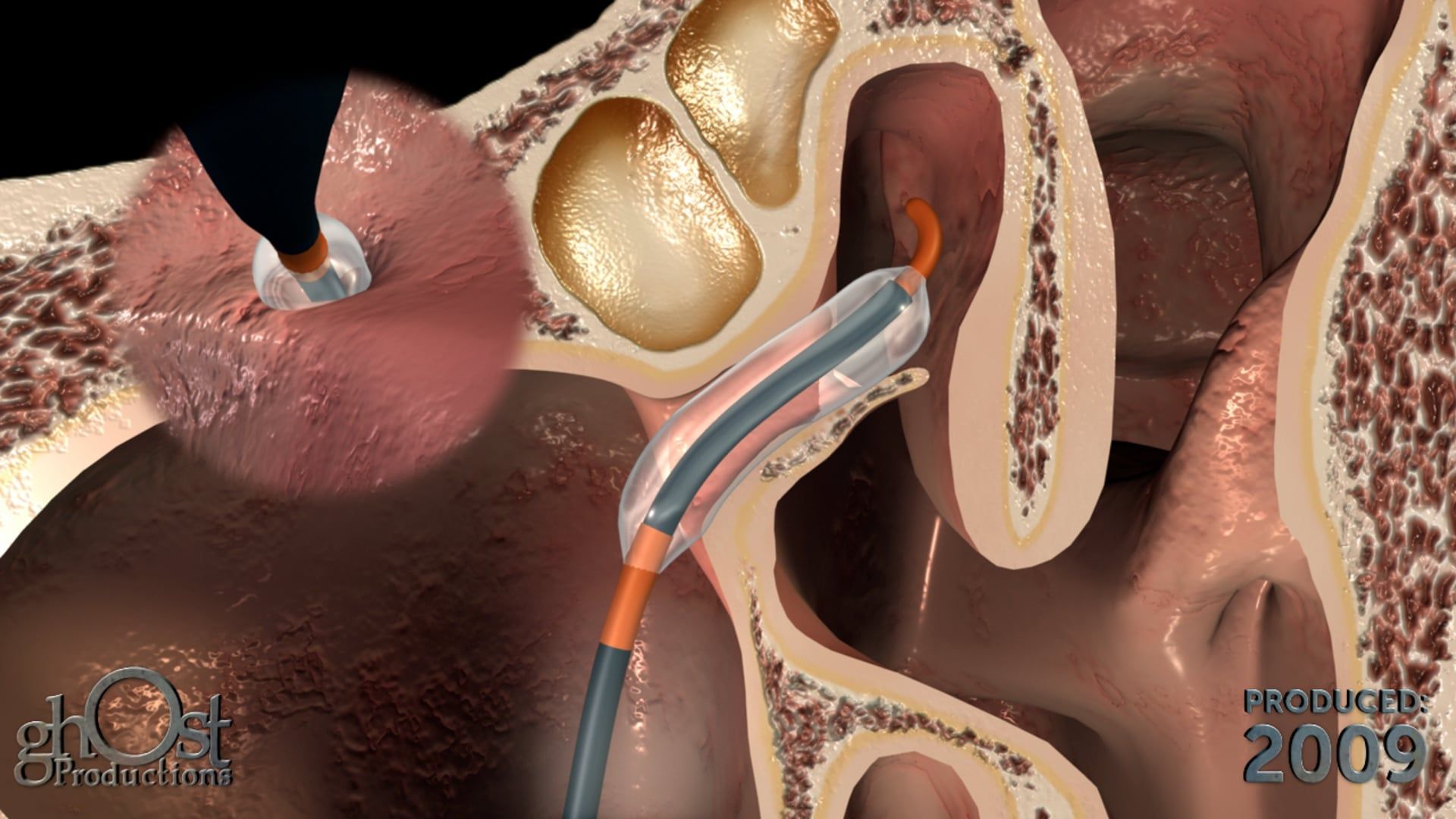 FinESS™ is a safe and effective in-office treatment for sinus issues, utilizing advanced technology to provide relief from symptoms.