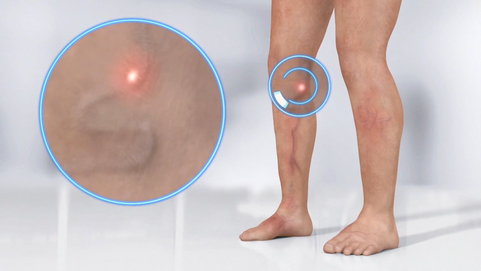 Varicose Veins Animated Video - Cardiovascular Institute of the South - Ghost Medical