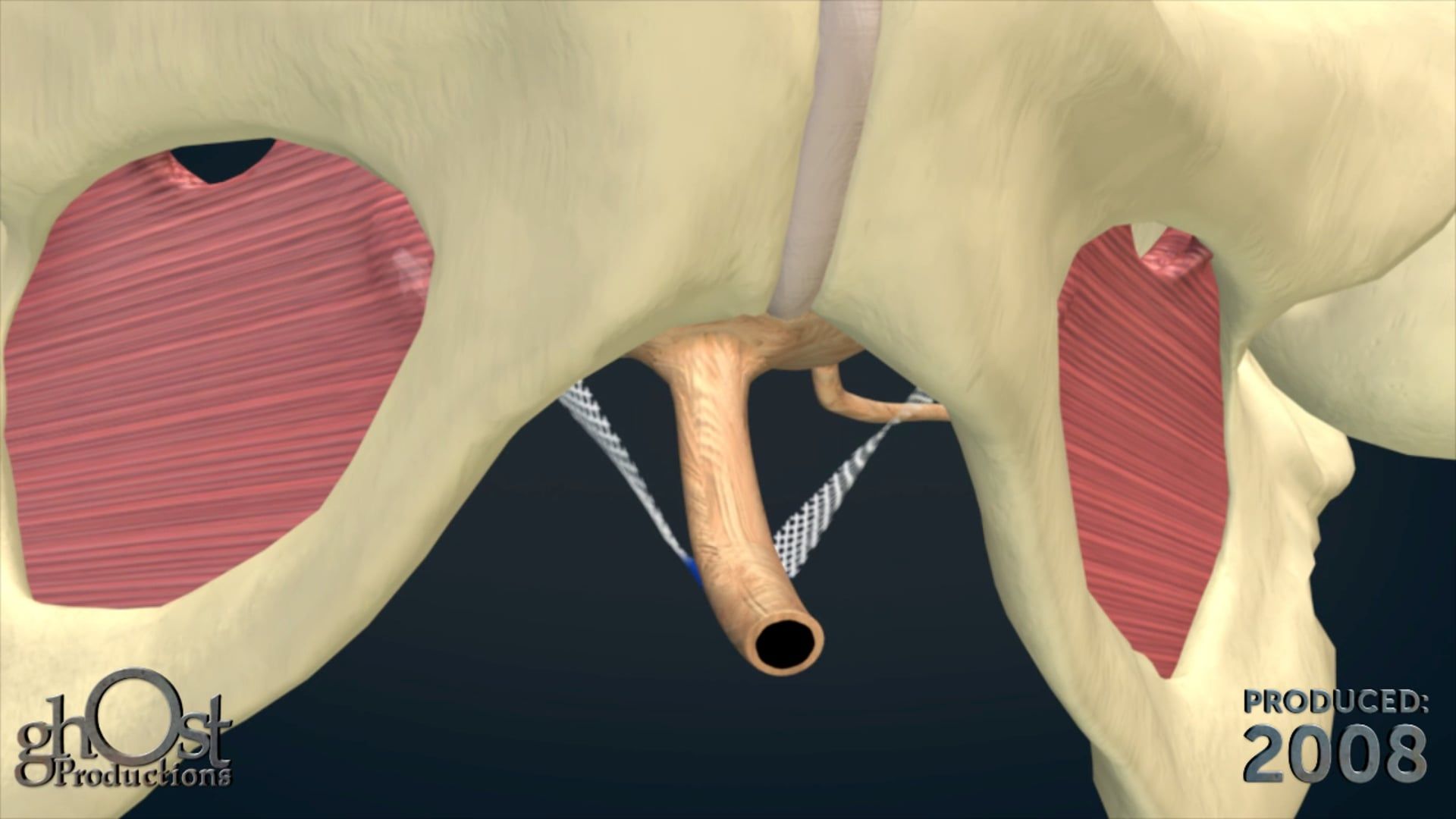 Introducing the MiniArc by Ghost Medical: Innovative Solutions for Pelvic Organ Prolapse
