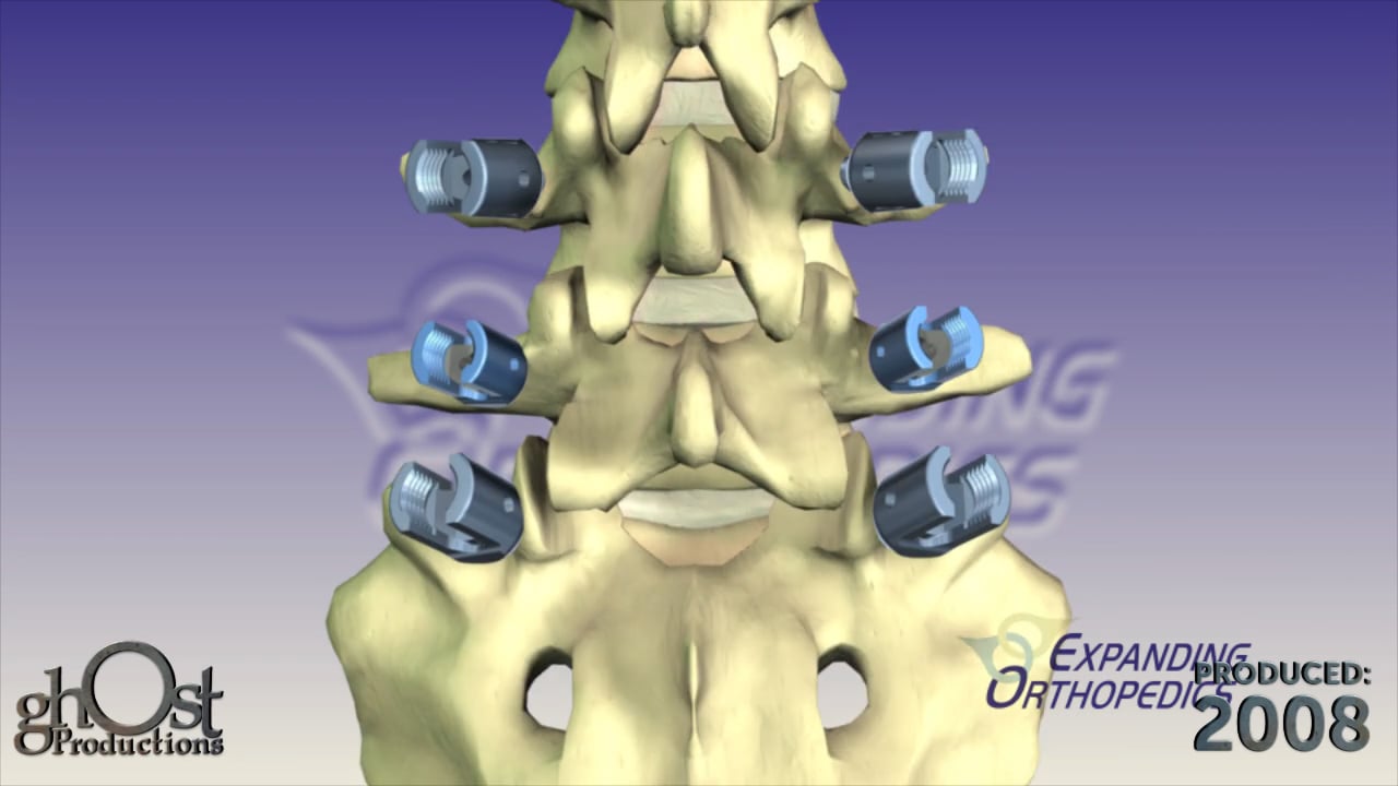Expanding Orthopedics, Ghost Productions, VCF posterior lumbar fixation system, spinal motion stabilization, interbody bone fusion, vertebral compression fractures, threaded interbody fusion cage, lumbar disc space, pedicle screws, optimal support, healing, medical professionals, cutting-edge technology, orthopedics.