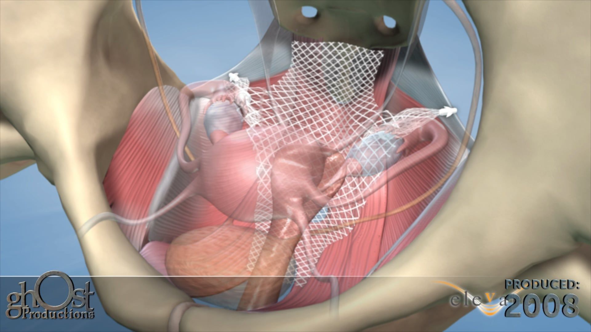 Elevate Procedure by Ghost Medical for American Medical Systems