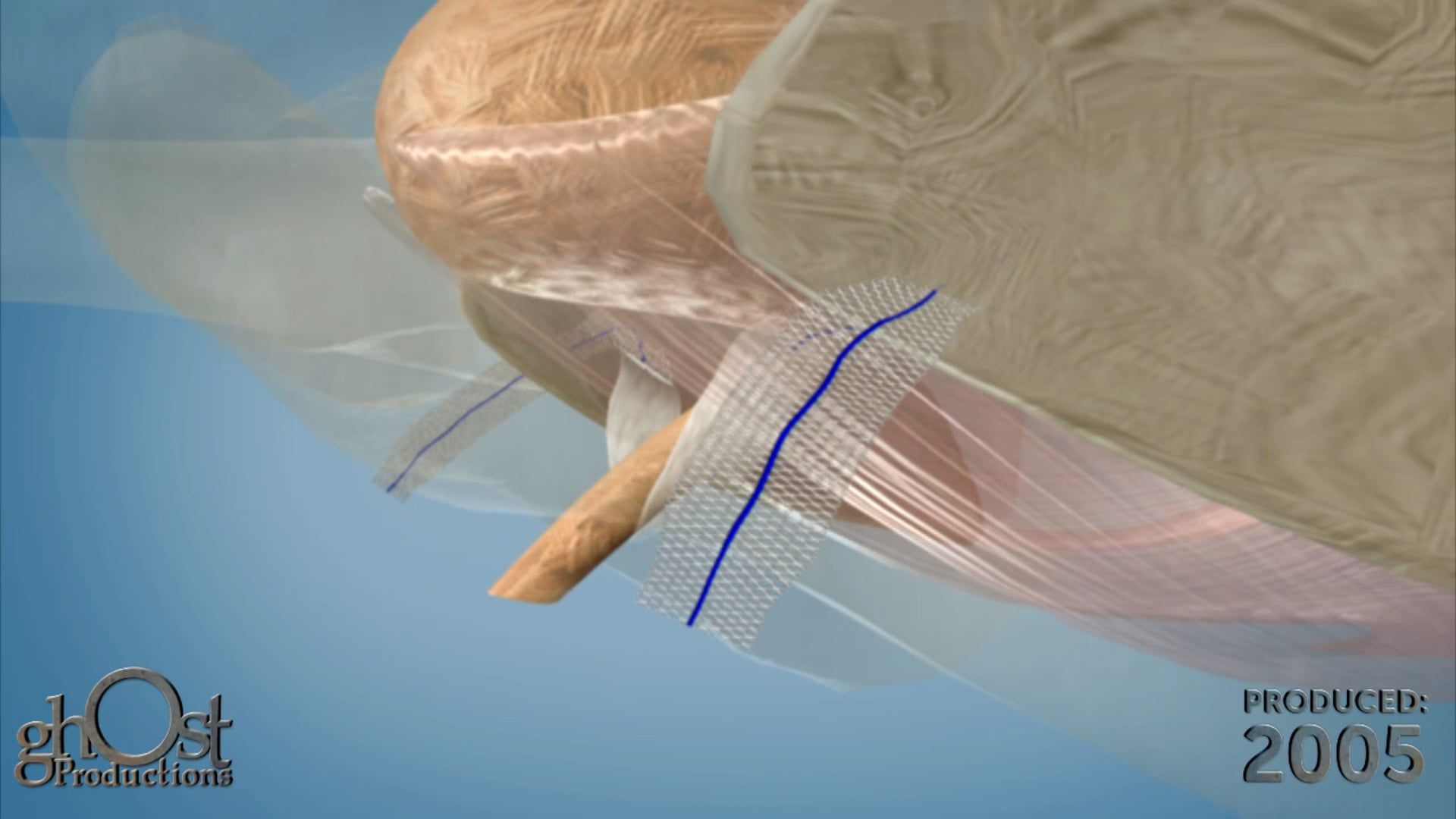 AMS BioArc, vaginal mesh, bladder prolapse, vaginal prolapse, biologic mesh, tissue integration, patient outcomes, medical device, long-lasting support, medical professionals, reliable solution, patient benefits, practice improvement.