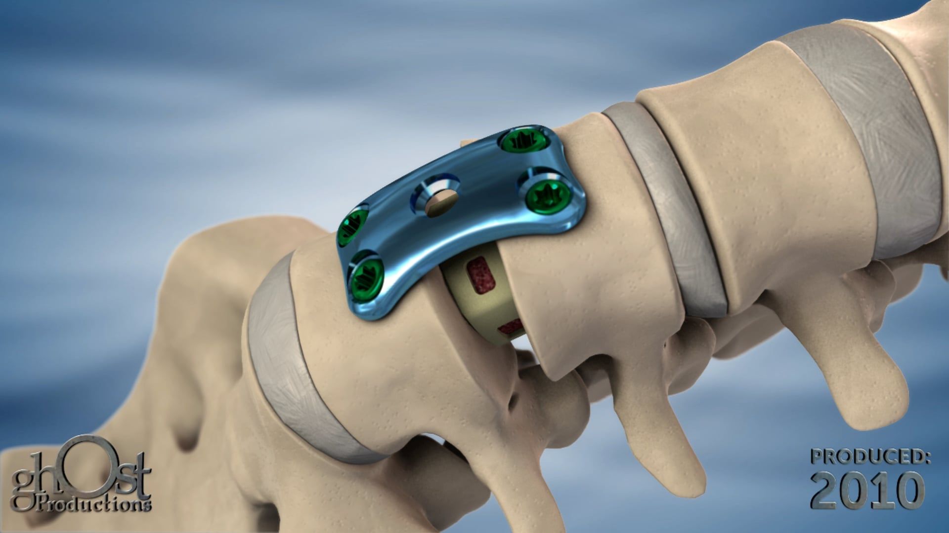 Ghost Medical Presents: K2M Cayman - A Revolutionary Spinal Implant System
