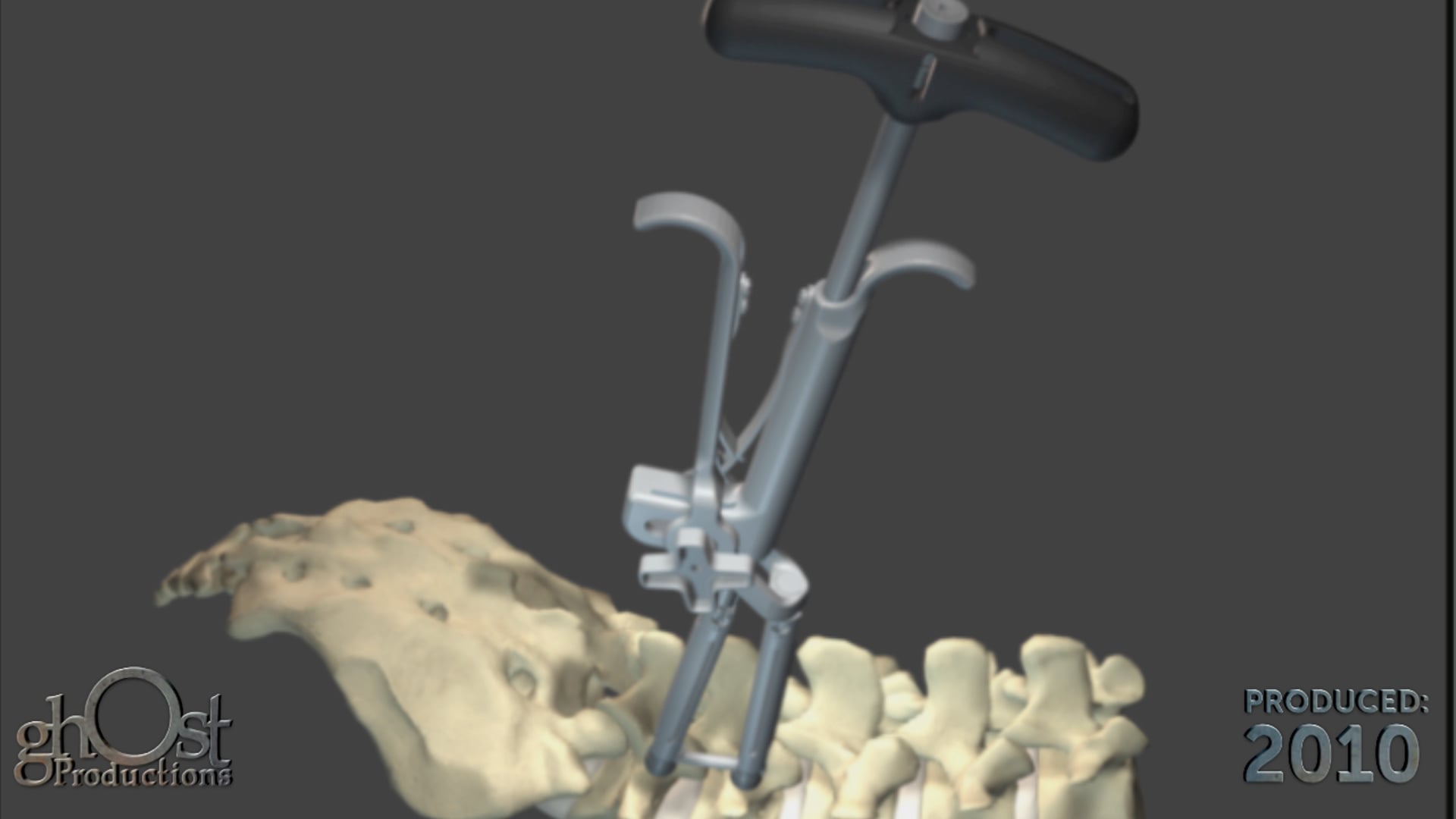 Zimmer Spine, Ghost Productions, medical device company, animation, surgical video, Pathfinder, Traxis systems, minimally invasive, transforaminal interbody spacer surgery, cutting-edge technology, spinal surgery, patient discomfort, recovery time, medically accurate, procedure, innovative products, valuable resource, medical professionals, patients, latest advancements, spinal surgery.