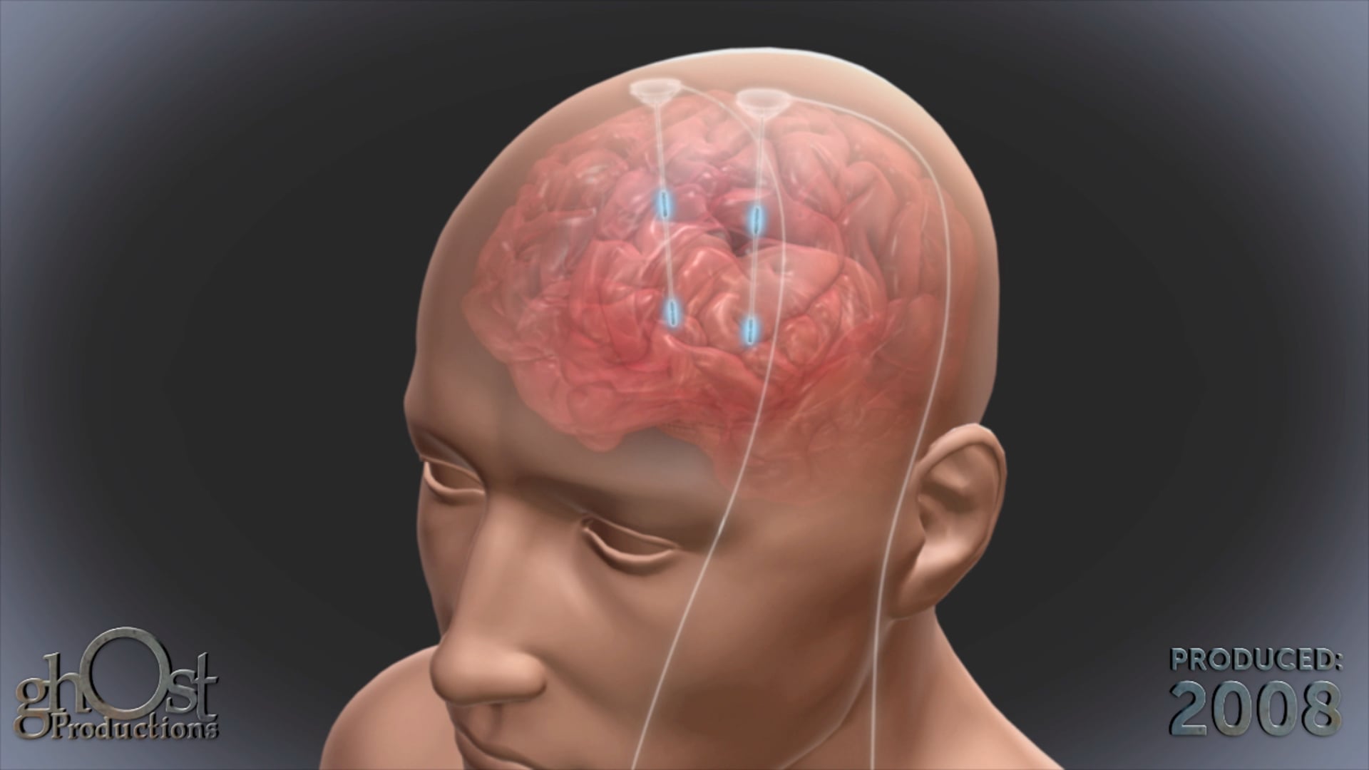 This video presents an animation of the human brain featuring an innovative implant known as a stentrode. 