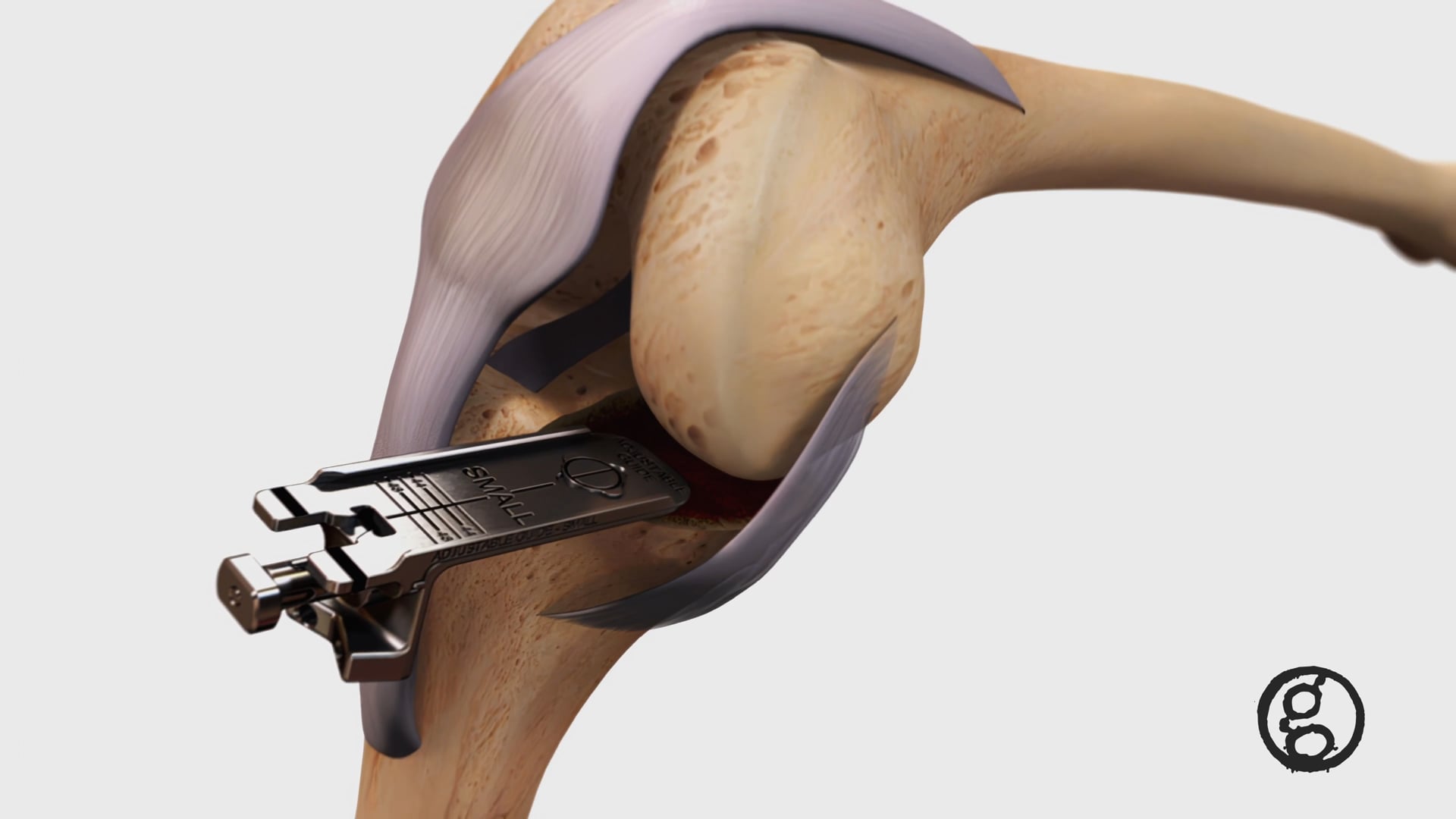 Ghost Medical - Zimmer Biomet Mirror™ Partial Knee Replacement Animation
