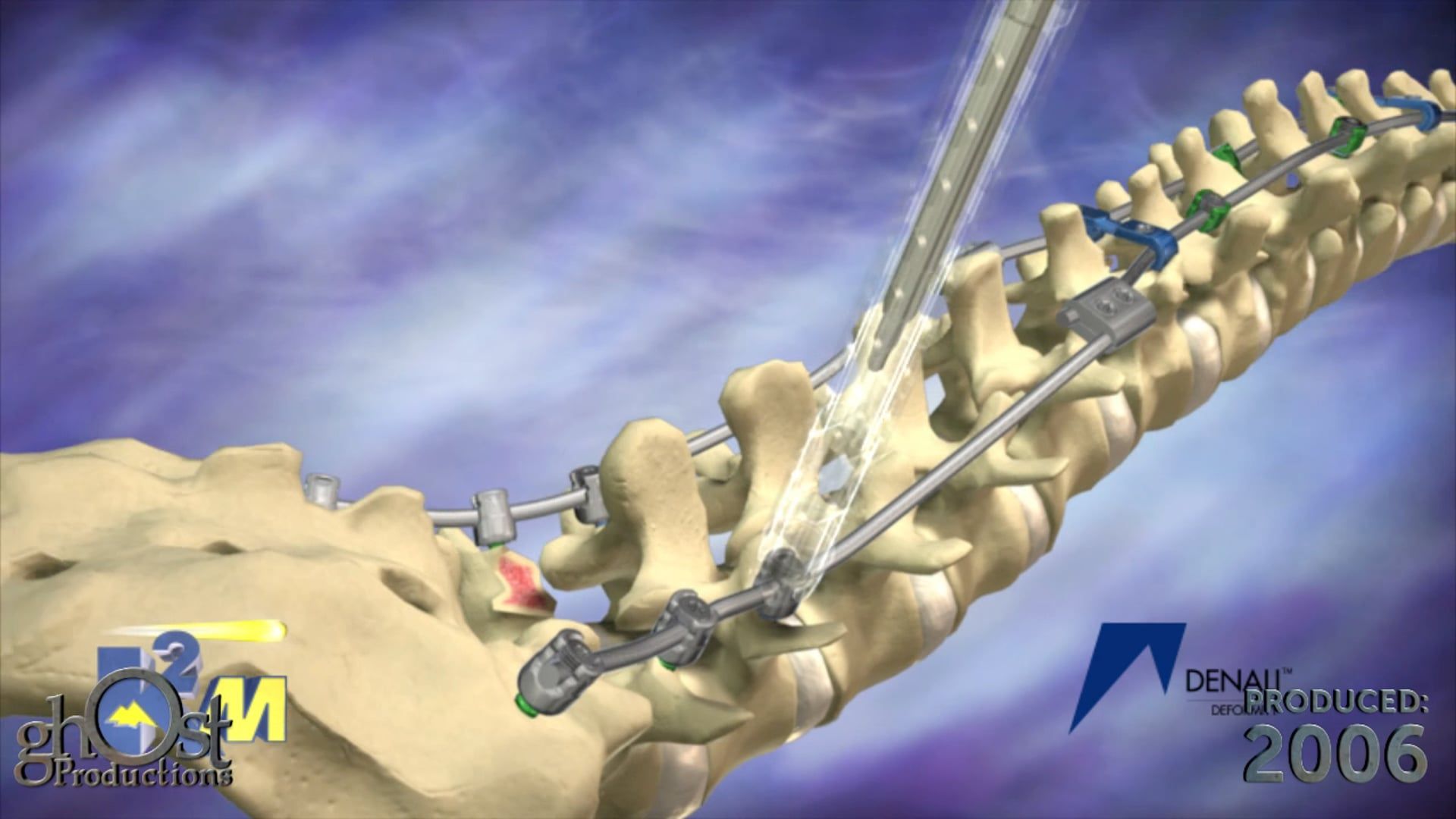 Ghost Productions, medical animation, K2M, Denali Deformity device, spinal pathologies, orthopedic surgeons, medical professionals, animation, medically accurate, unique features, benefits, showcase, potential clients, patient outcomes, spinal surgery.
