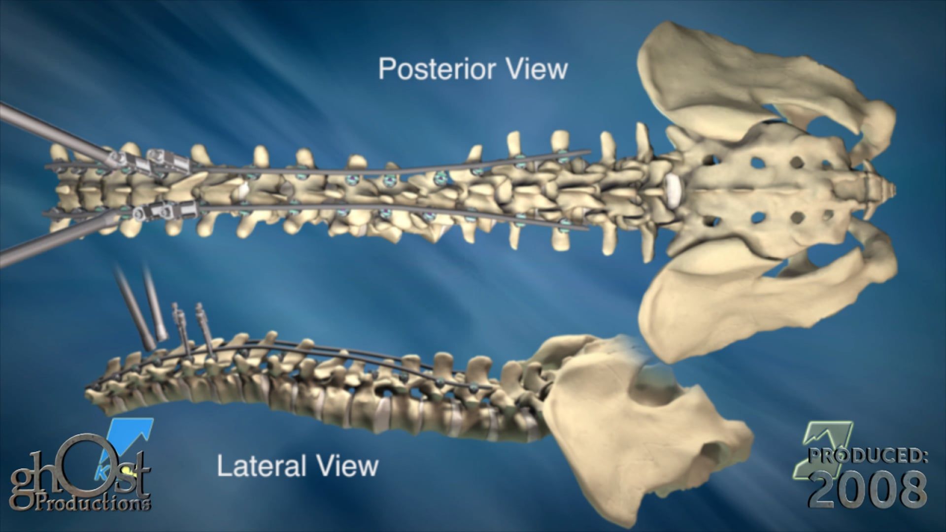 medical animation, K2M, Range Complex Spine Technology, thoracolumbar device, spinal pathologies, Kyphoscoliosis Spinal Deformity, surgical technique, medical professionals, spinal surgery, medical devices, innovative technology, visual demonstration, medical education, surgical innovation, medical visualization