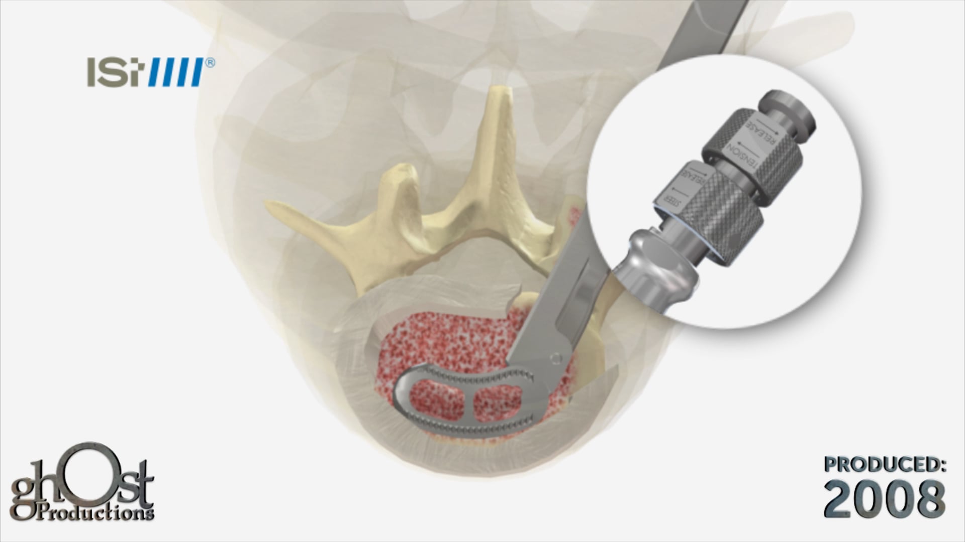 Revolutionary Spinal Solution: Ghost Medical's Axient