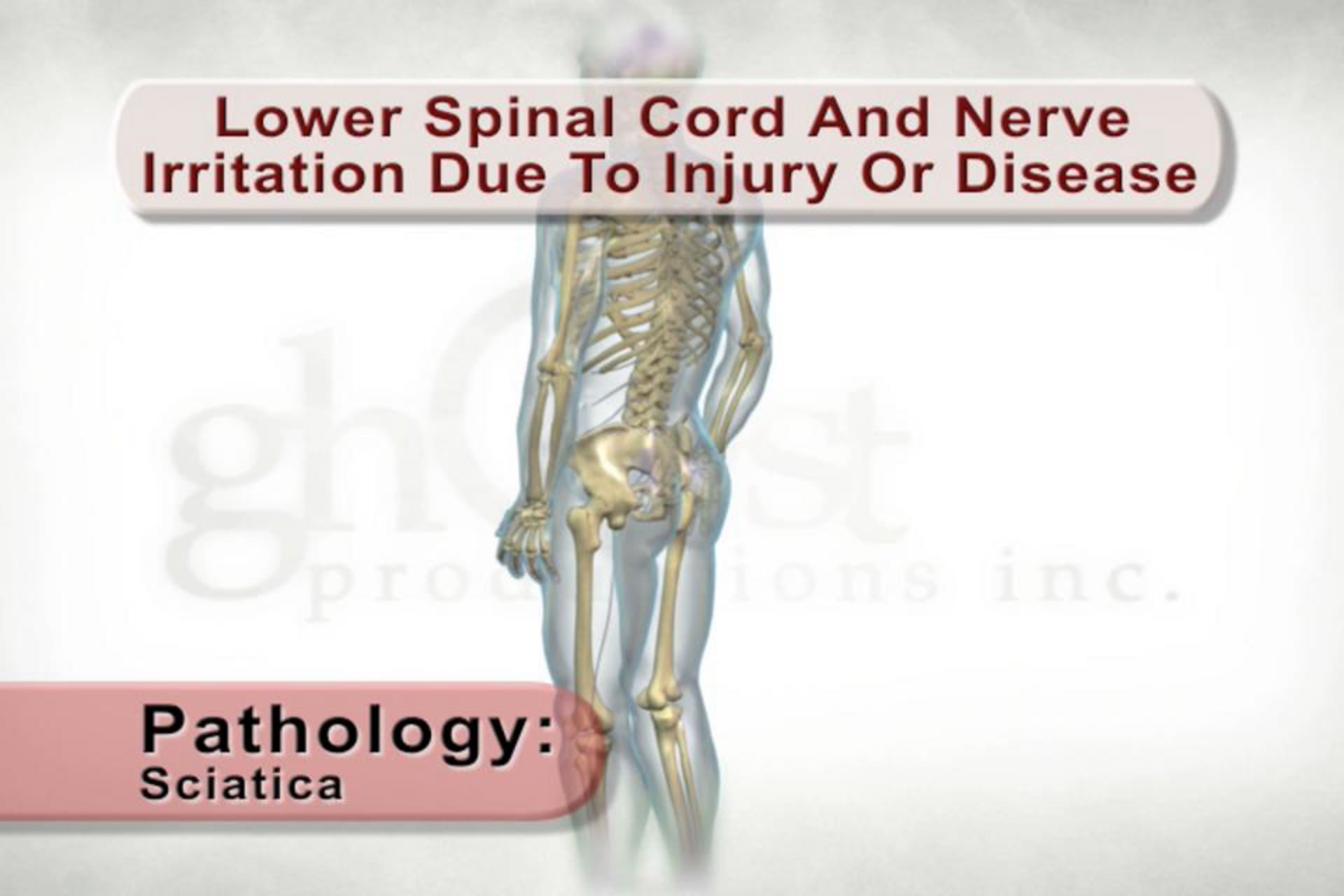 medical animation, lower spinal cord, nerve irritation, Sciatica, radiating pain, gluteus, upper leg, lower leg, injury, disease, healthcare professionals, patients, causes, symptoms, educational overview, Ghost Productions, 2006, medical accuracy, resource, distribution, .edu, .org, active link, www.ghostproductions.com.