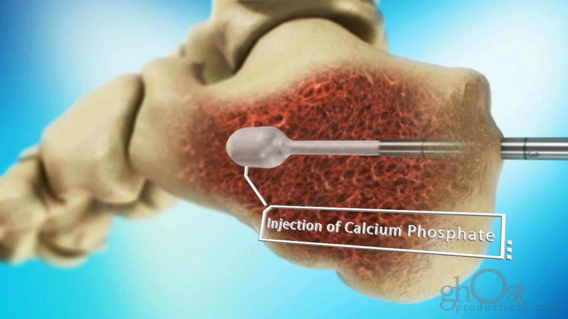 Medtronic Spine, Ghost Productions, character animation, InflateFX Fracture Management system, cutting-edge technology, fracture management, marketing tool, educational tool, healthcare professionals, patients, medically accurate, key features, benefits, advancements, technology.